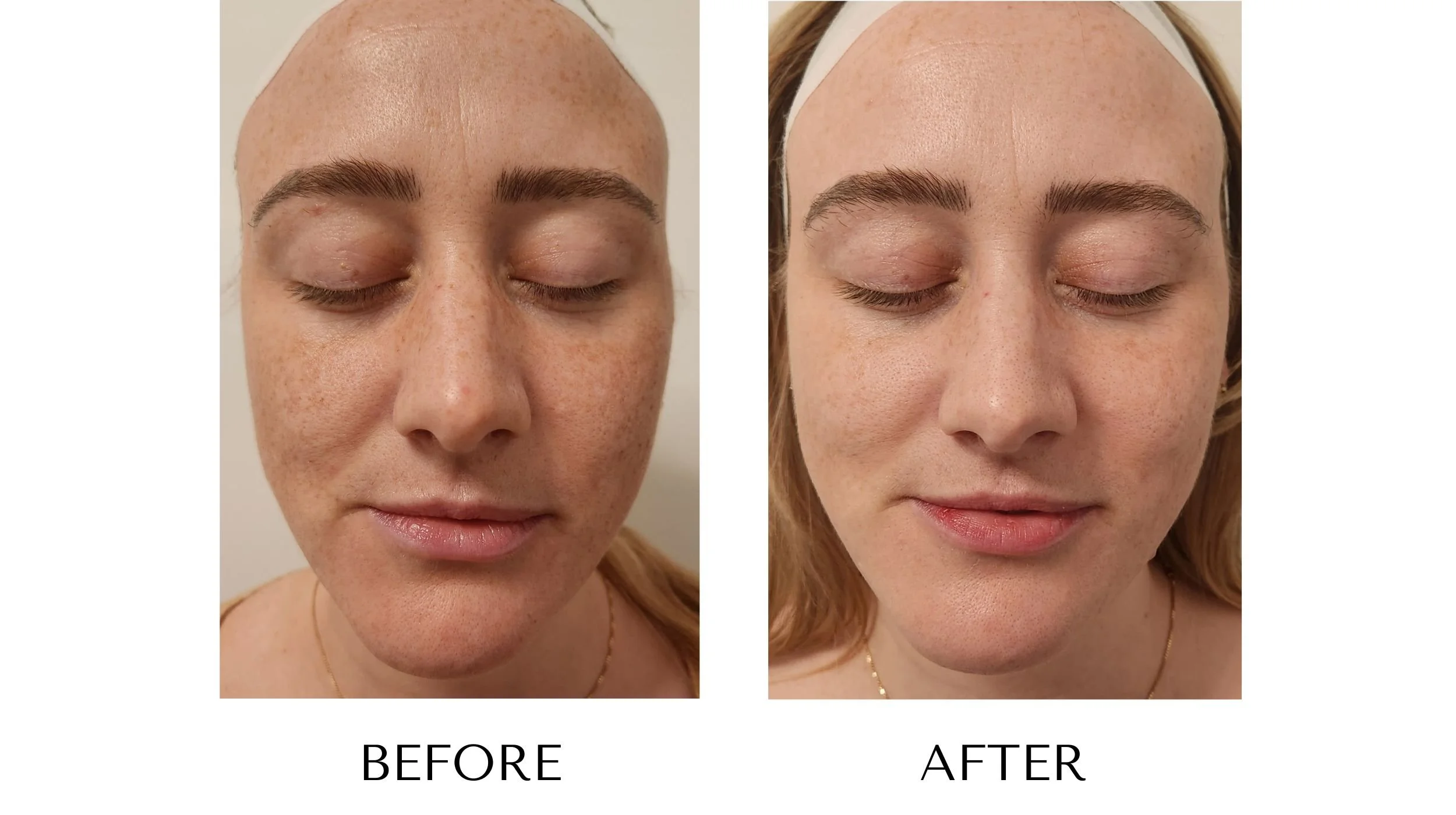 NUYU-laser-skin-rejuvenation-ipl-photofacial-results-7.jpg