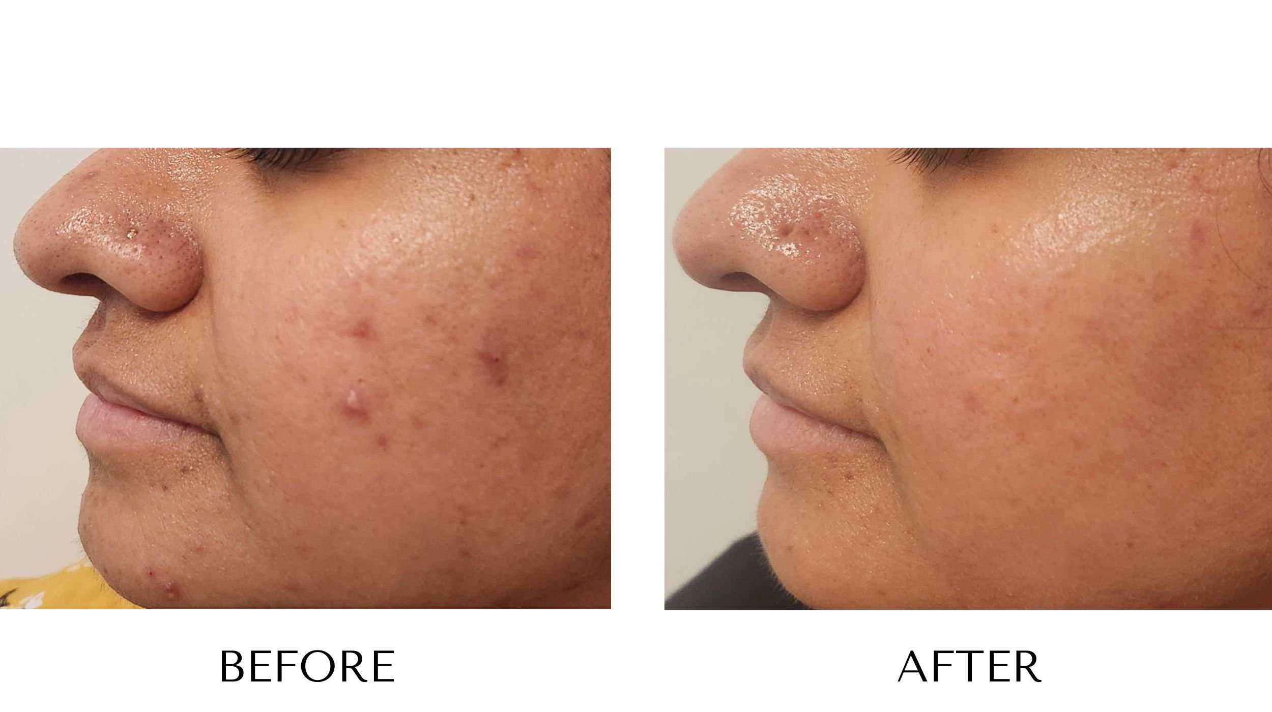 Before and after ProCell Microchanneling at NUYU Laser & Skin Rejuvenation in Belleville, Ontario, showing reduced acne scarring, improved skin tone and hyperpigmentation, enhanced skin elasticity, and a more youthful glow.