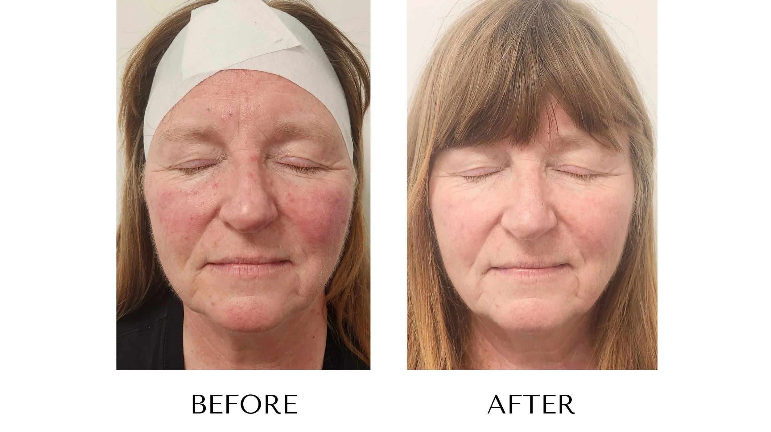 Before and after photos of an IPL photofacial treatment at NUYU Laser & Skin Rejuvenation in Belleville, Ontario, showing improved rosacea, facial redness, and broken capillaries.