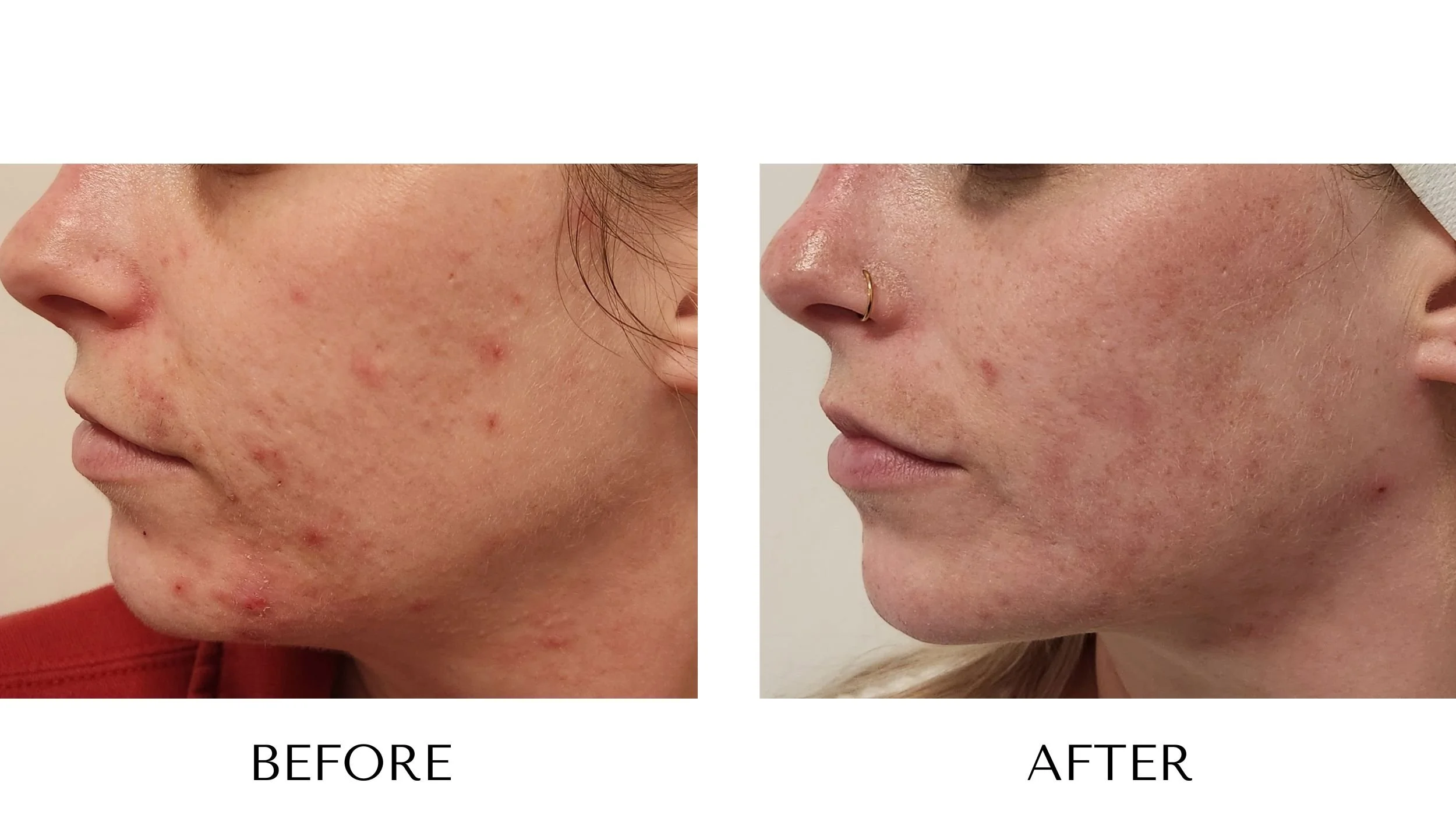 Before and after laser acne treatment at NUYU Laser & Skin Rejuvenation in Belleville, Ontario, showing clearer, smoother skin and reduced acne for moderate/severe acne, clogged pores, inflammation, and PIH (post-inflammatory hyperpigmentation).