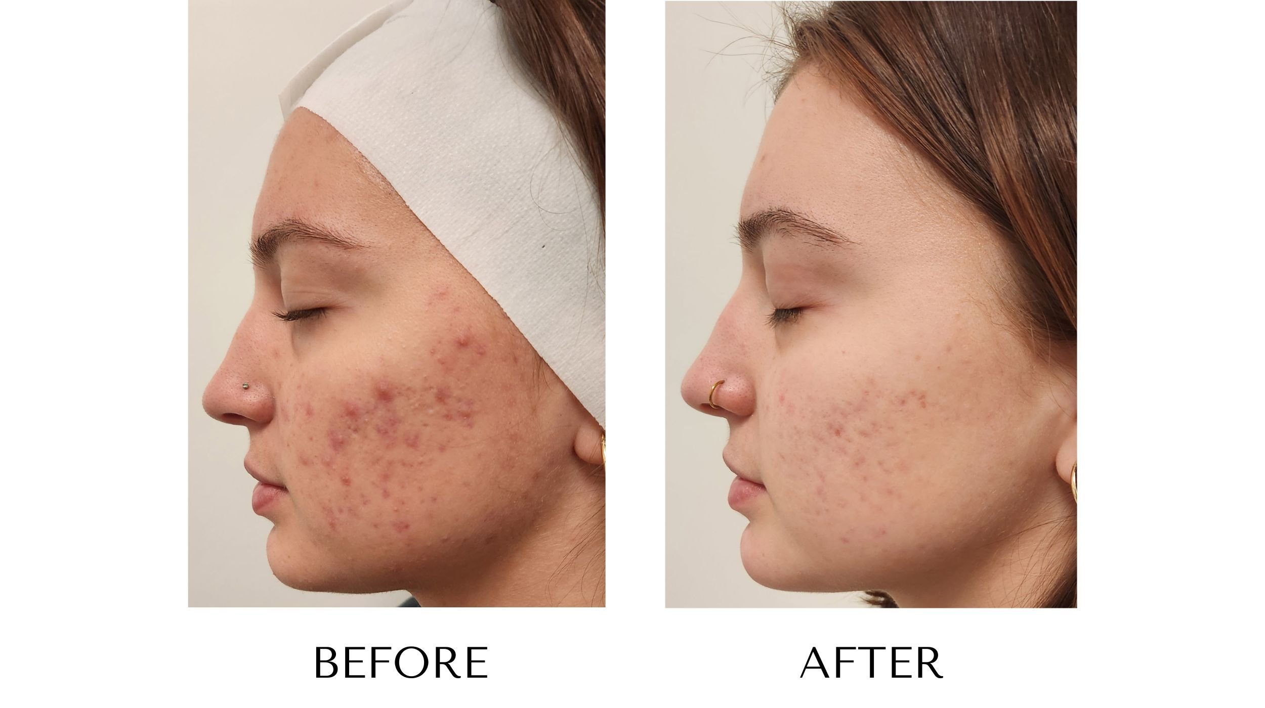 Before and after laser acne treatment at NUYU Laser & Skin Rejuvenation in Belleville, Ontario, showing clearer, smoother skin and reduced acne for moderate acne, inflammation, and PIH (post-inflammatory hyperpigmentation).