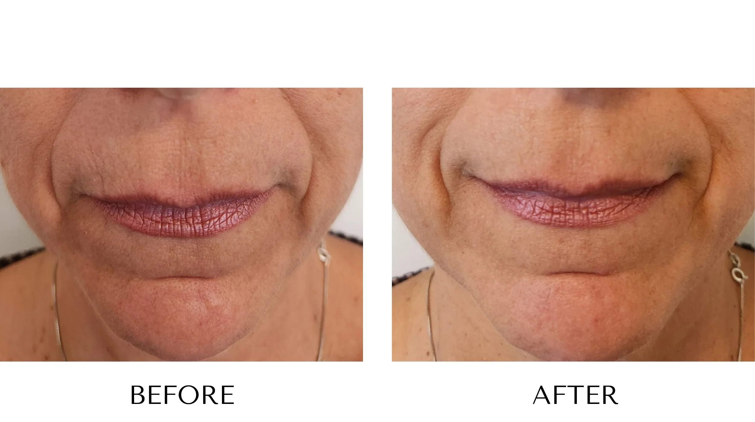 NUYU-laser-skin-rejuvenation-pp-duo-nasolabial-folds-results-1.jpg