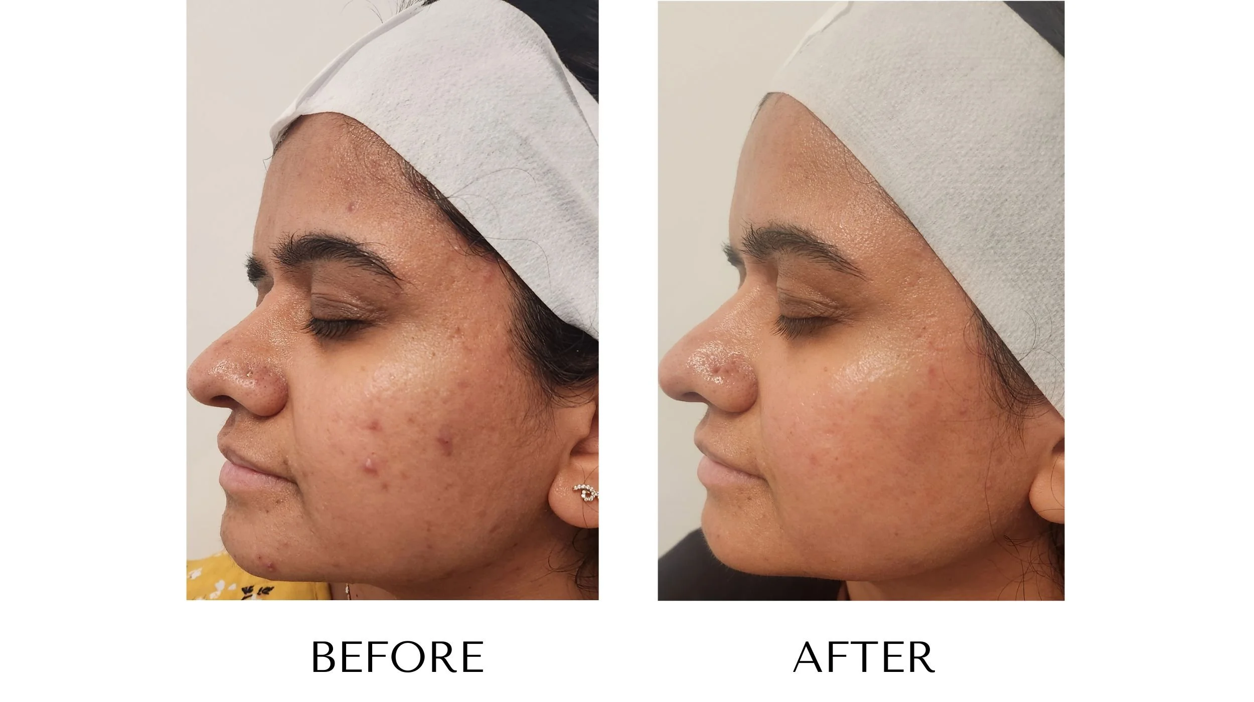 Before and after laser acne treatment at NUYU Laser & Skin Rejuvenation in Belleville, Ontario, showing clearer, smoother skin and reduced acne for mild acne, inflammation, and PIH (post-inflammatory hyperpigmentation).
