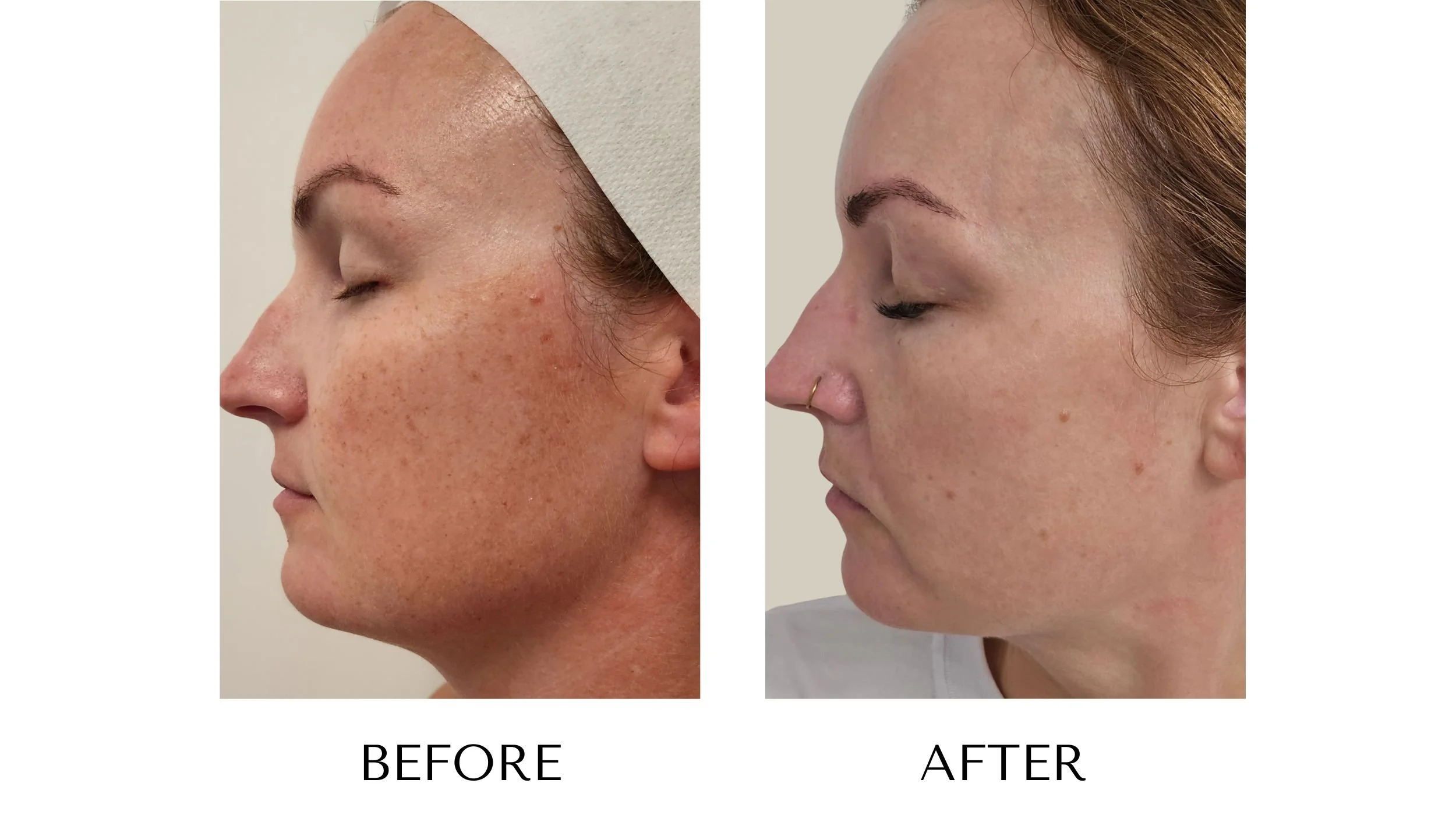 Before and after photos of an IPL photofacial treatment at NUYU Laser & Skin Rejuvenation in Belleville, Ontario, showing improved sun damage.