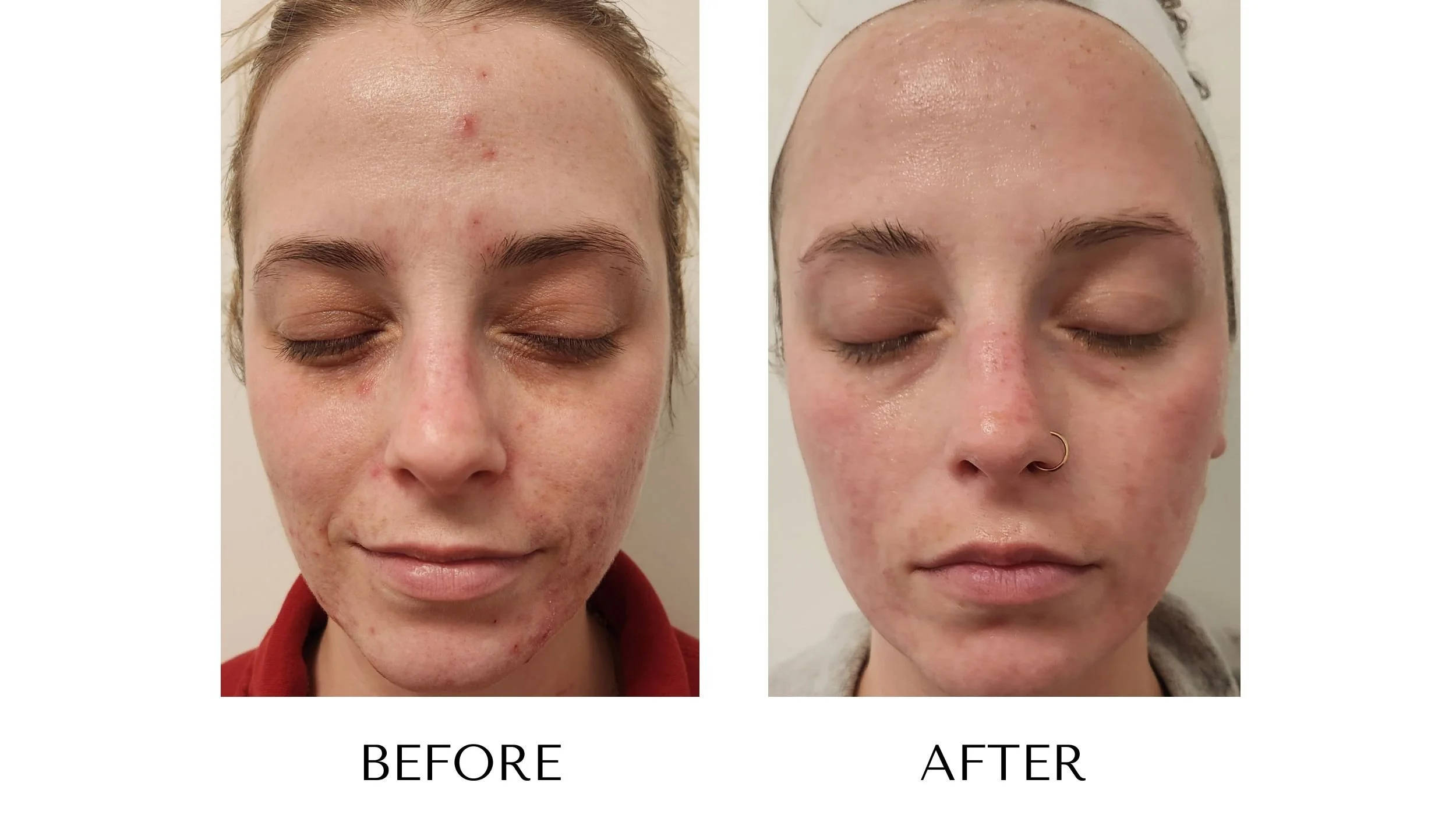 Before and after laser acne treatment at NUYU Laser & Skin Rejuvenation in Belleville, Ontario, showing clearer, smoother skin and reduced acne for moderate/severe acne, clogged pores, inflammation, and PIH (post-inflammatory hyperpigmentation).