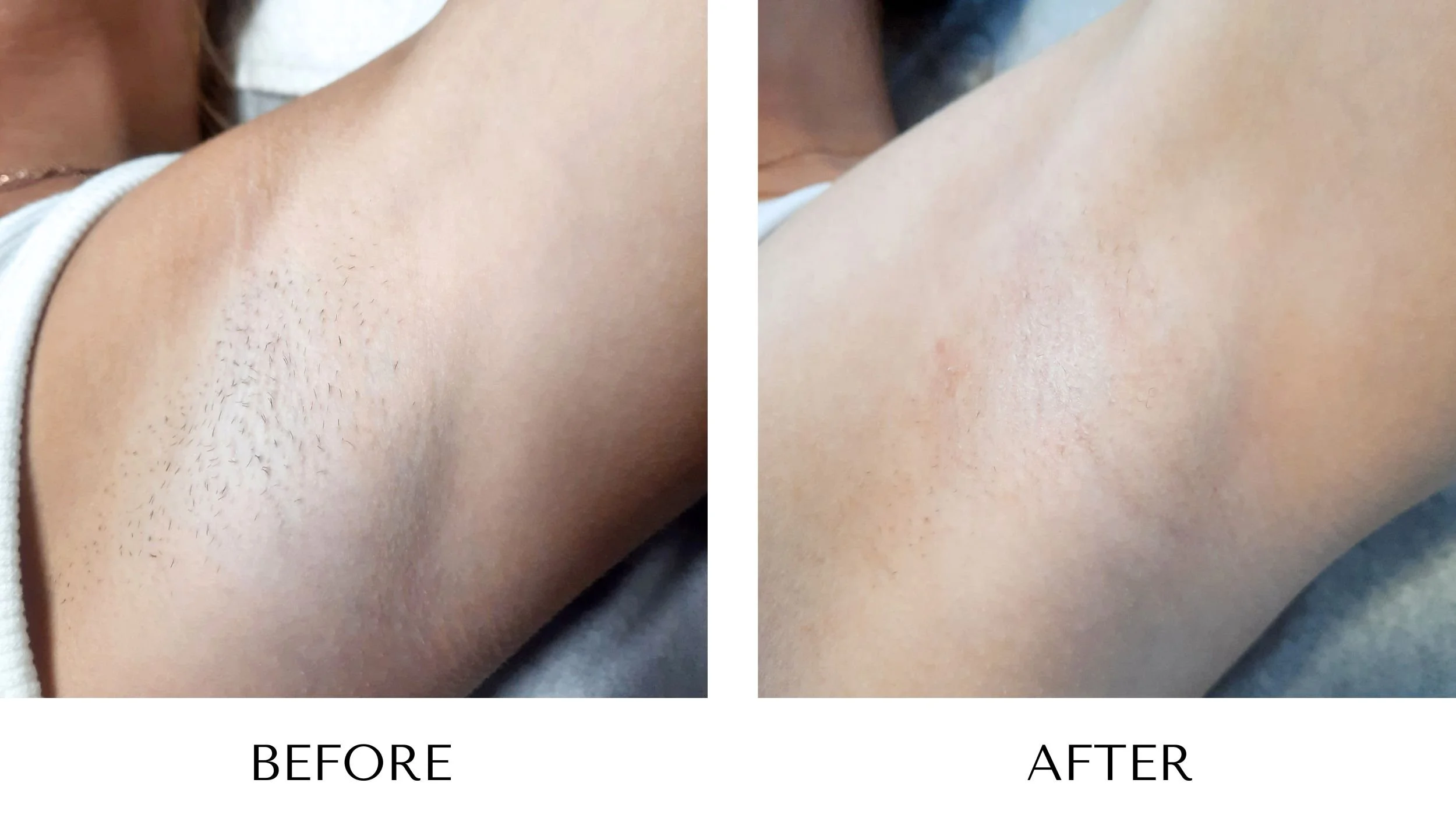 Before and after photos of women’s underarms laser hair removal at NUYU Laser & Skin Rejuvenation in Belleville, Ontario, showing reduced hair growth and smoother skin.