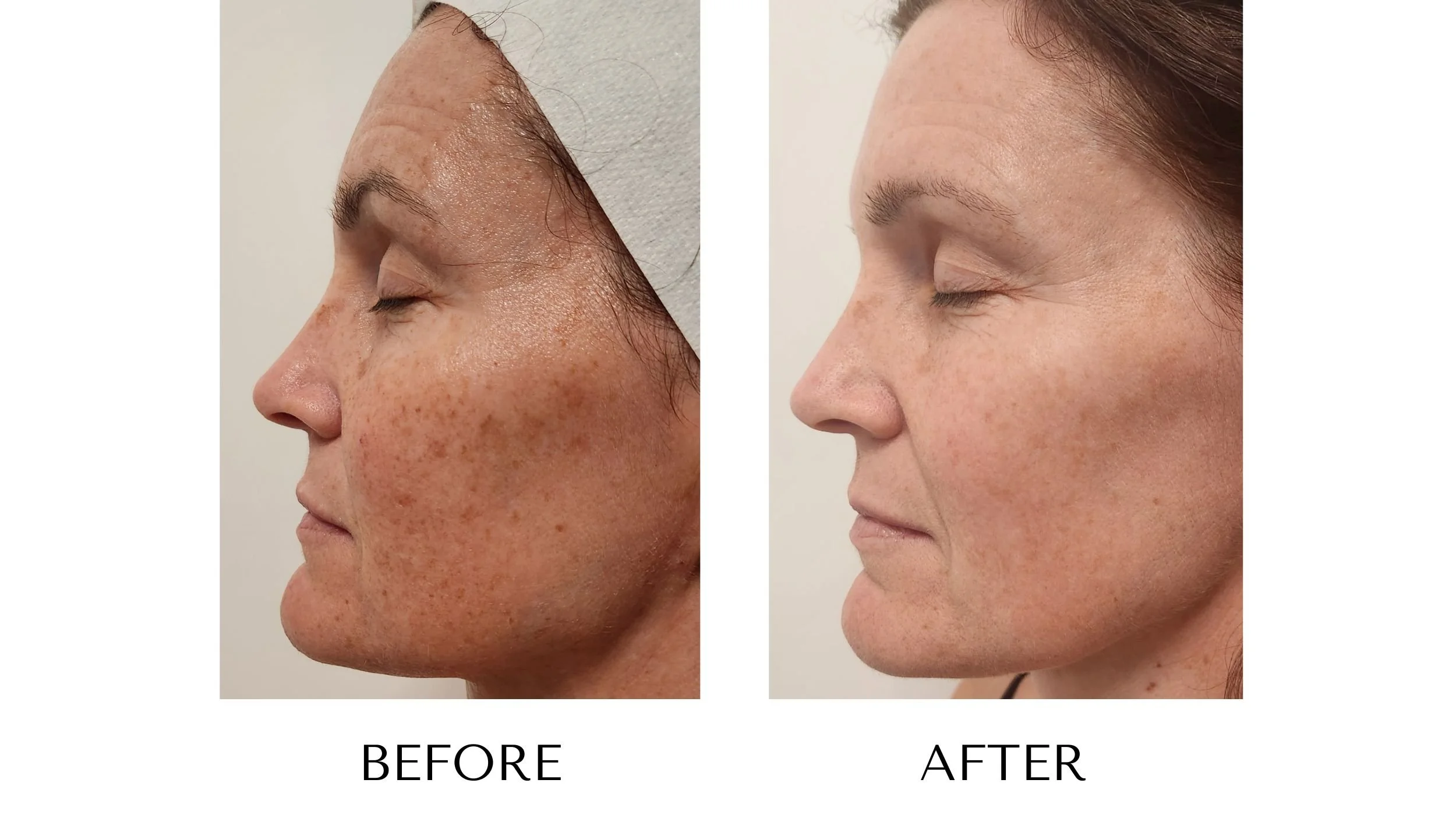 Before and after photos of an IPL photofacial treatment at NUYU Laser & Skin Rejuvenation in Belleville, Ontario, showing improved skin tone and texture.