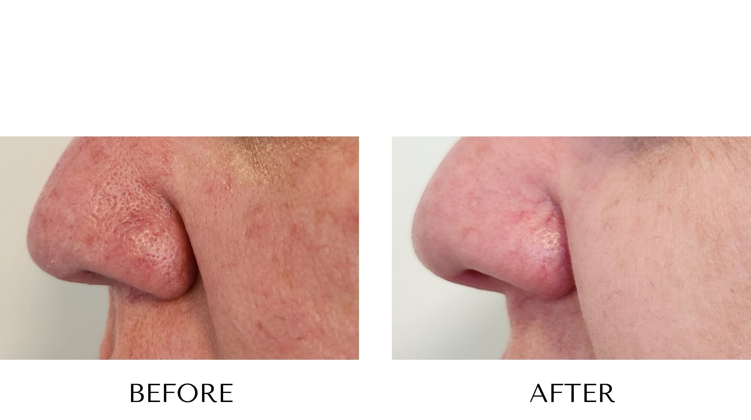 NUYU-laser-skin-rejuvenation-ipl-photofacial-rosacea-results-4.jpg