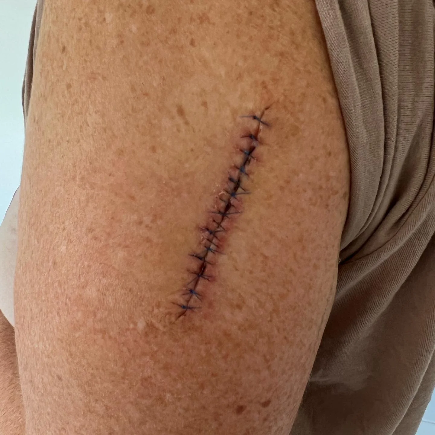 Hey 👋🏼 

So&hellip;.

Have been having some health issues going on this year. 

One of which has been this&hellip;&hellip;a big ol nasty Melanoma. 

So in the spirit of helping someone else - I implore you all to book in for a skin check. 

Left un