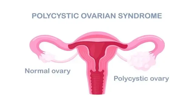 PCOS- What is it and how can a Naturopath help