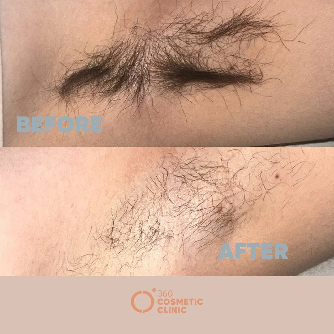 Laser Hair Removal Results after 1 Session -magic✨🤩

After each session your hair will be permanently reduced by 10-20%. 

On average 6-8 sessions are required for up to 95% hair reduction. 

What are you waiting for? 

📍 Located inside Loft Cosmet