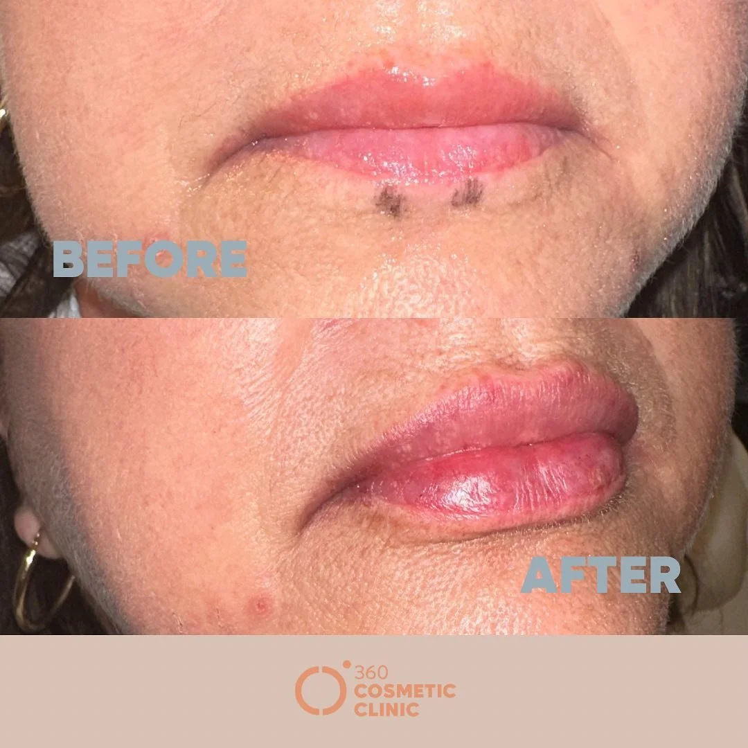 &ldquo;Plump, pout, and perfect! 💋✨ Elevate your lip game 

📌 Located inside Loft Cosmetic Niagara Falls, ON

💵 DM for pricing 

🤕 Bruising &amp; swelling can occur 

📆 Allow 2 weeks to heal 

Non Surgical Anti-aging Treatments 

💉skin booster
