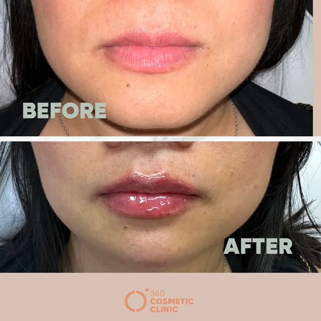 &ldquo;Because life is too short for thin lips! 💄✨ Embracing the plump and fabulous! 

Posted with permission. 

📍 Location inside Loft Cosmetics
💵 DM to inquire 
🤕 Bruising and swelling may occur (up to 2 wks to heal) 

Non Surgical Anti-aging T