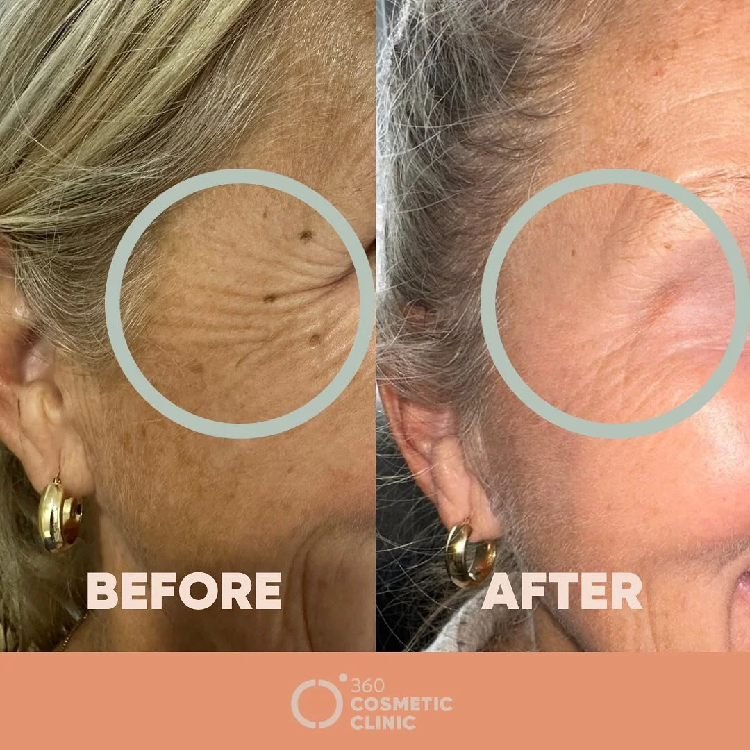 ✨ Tox&rsquo;d &amp; Tight Gaze ✨
Treat your crow&rsquo;s feet for a smoother, more youthful gaze! Botox is your secret weapon for erasing those pesky wrinkles and bringing back that radiant sparkle in your eyes. 

Botox is a popular non-surgical trea