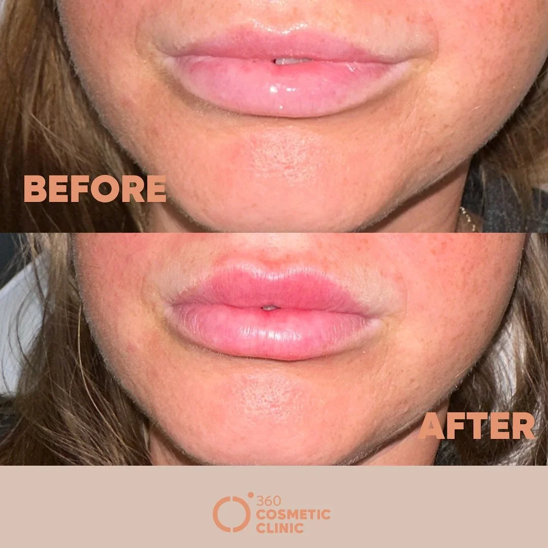 &ldquo;💖 Plump it up! Unlock your best smile with luscious lips that speak volumes. Whether it&rsquo;s a subtle enhancement or a bold transformation, let your confidence shine through every pout! 💋✨