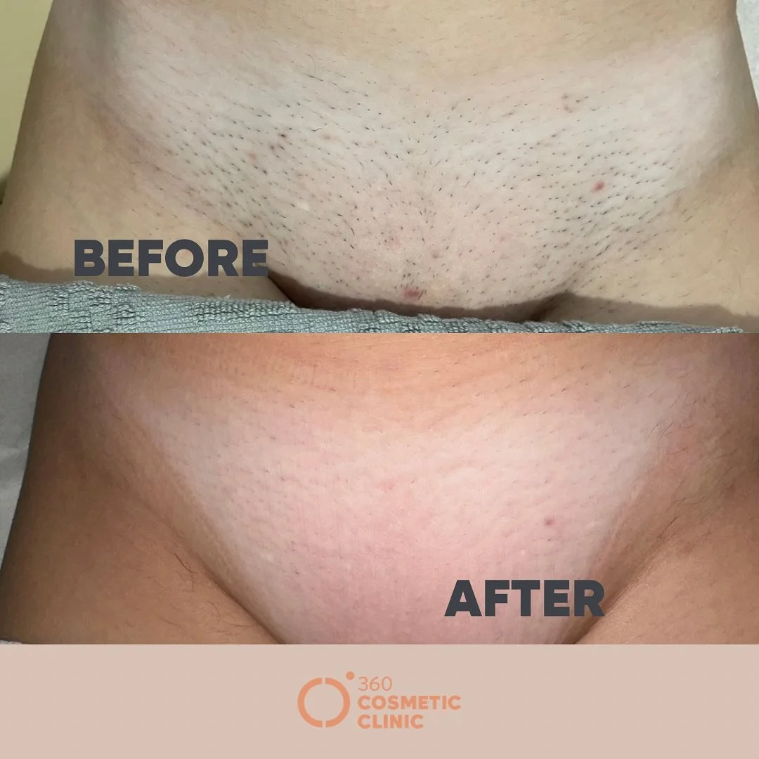 Experience the freedom of flawless bikini area skin 🌟 

The most Affordable Laser Hair Removal  in Niagara 

🚫more shaving 
🚫more waxing 

Our advanced technology targets hair follicles with precision, ensuring long-lasting results and minimal dis