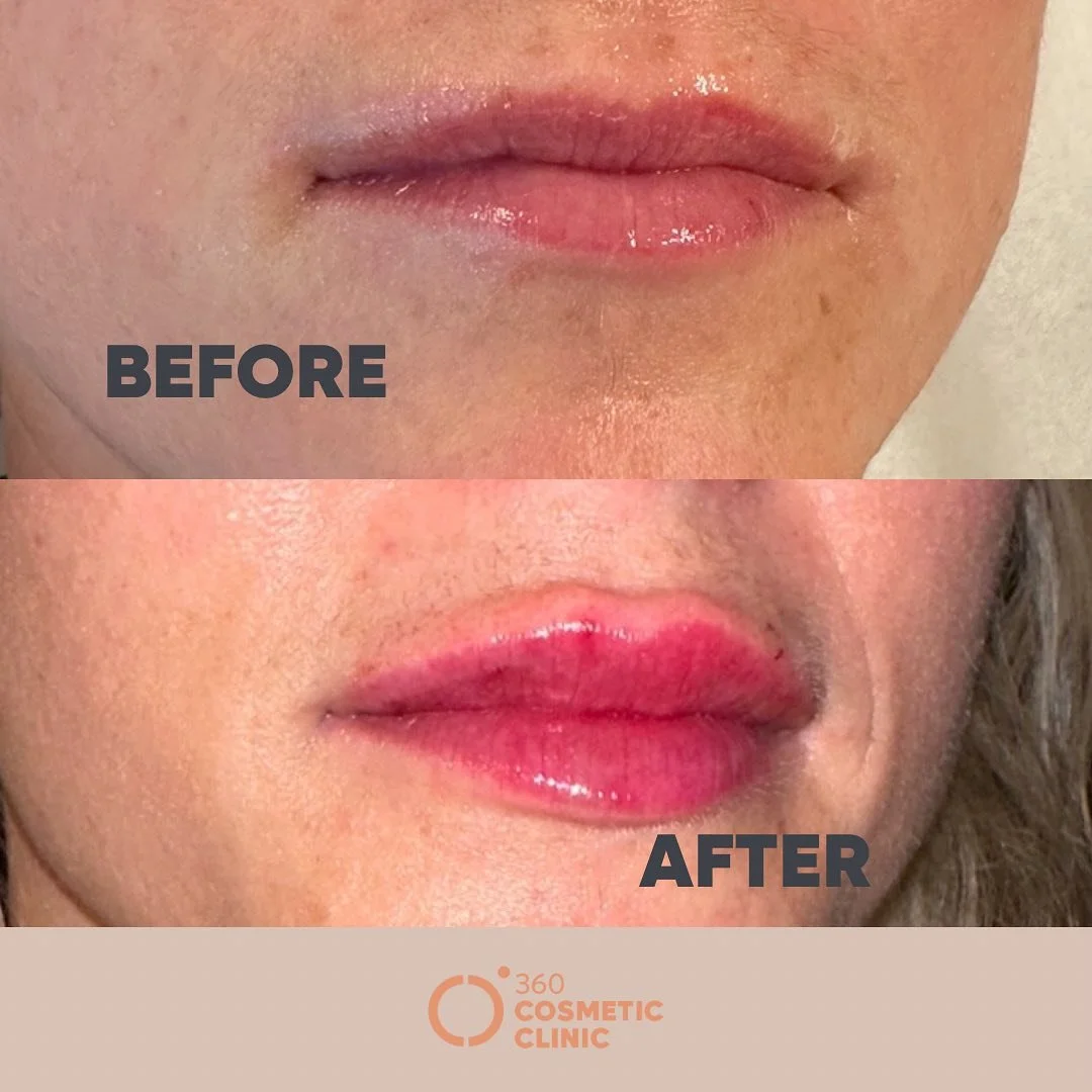 💋💉LIPS OH SO KISSABLE 💉💋
Elevating your natural beauty one syringe at a time. Remember, it&rsquo;s all about enhancing your unique features! Ready to make those lips pop? 

📍Inside Loft Cosmetic Clinic, Niagara Falls, ON
💵$299-475 
🤕 Bruising 