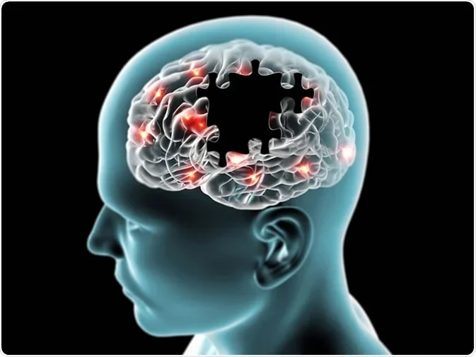 Treating Alzheimer's disease in a person living with HIV