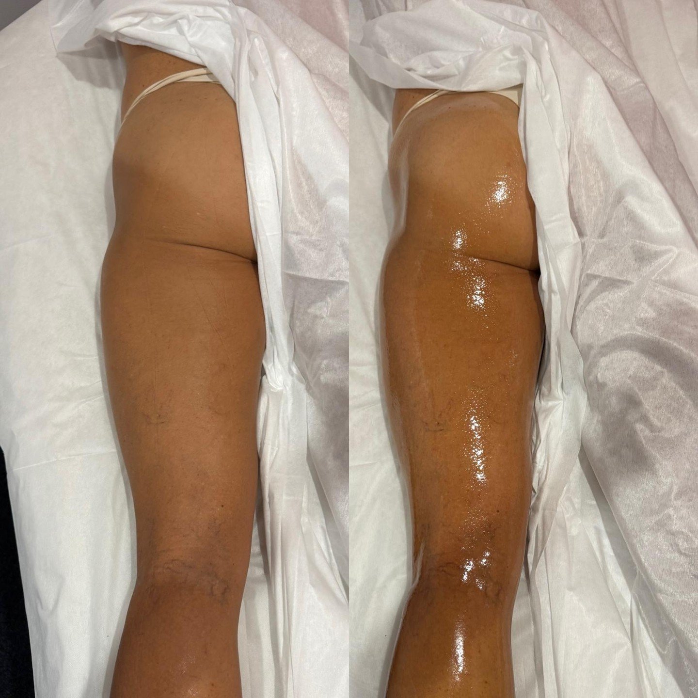 Do your legs feel heavy, tight or swollen by the end of the day?

The legs and lower body are common areas for fluid to pool, especially if you sit or stand for long periods, exercise frequently or experience hormonal shifts.

Lymphatic massage helps