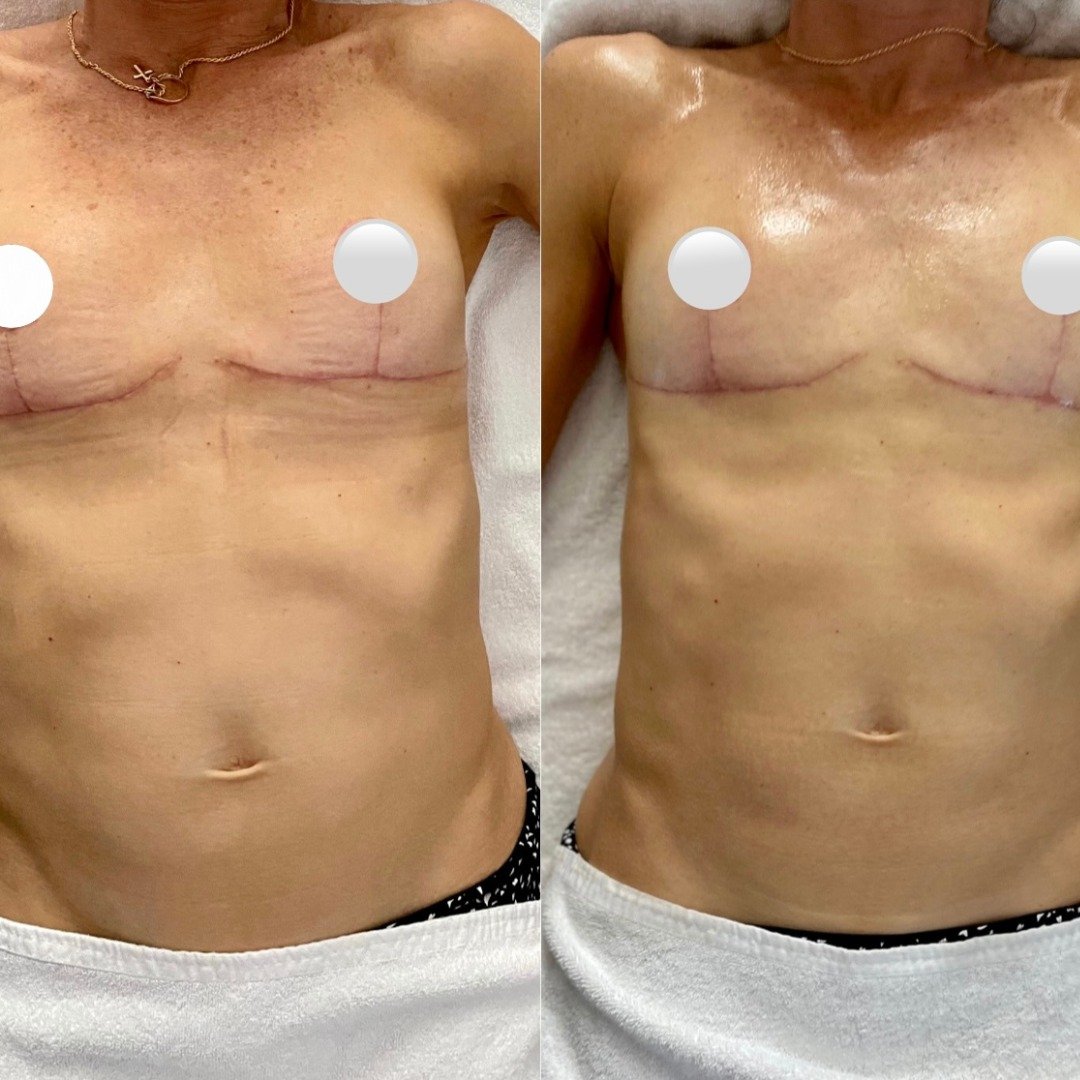Recovering from breast implant removal? Lymphatic massage can play a supportive role in your healing.

After explant surgery, the body works hard to clear fluid, reduce inflammation and settle the surrounding tissues. Lymphatic massage helps encourag