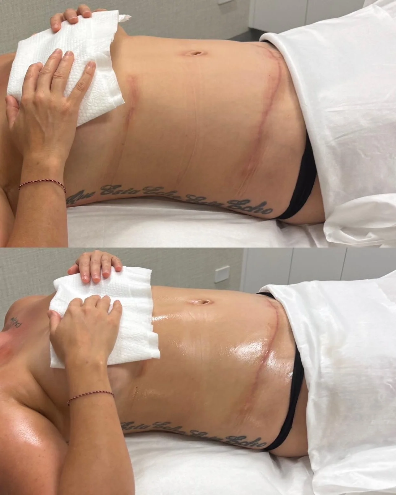 Many people think post-operative swelling just needs time. ❤️&zwj;🩹
⠀⠀⠀⠀⠀⠀⠀⠀⠀
Time is important, but so is lymphatic support. After surgery, the lymphatic system is responsible for clearing fluid and supporting tissue healing. Gentle post operative 