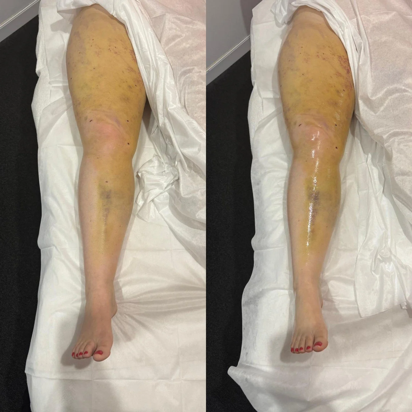 After surgery, swelling and fluid retention are part of the healing process.

Before and after images can show how the body responds when lymphatic pathways are gently encouraged to move fluid away from affected areas. Lymphatic massage is used along