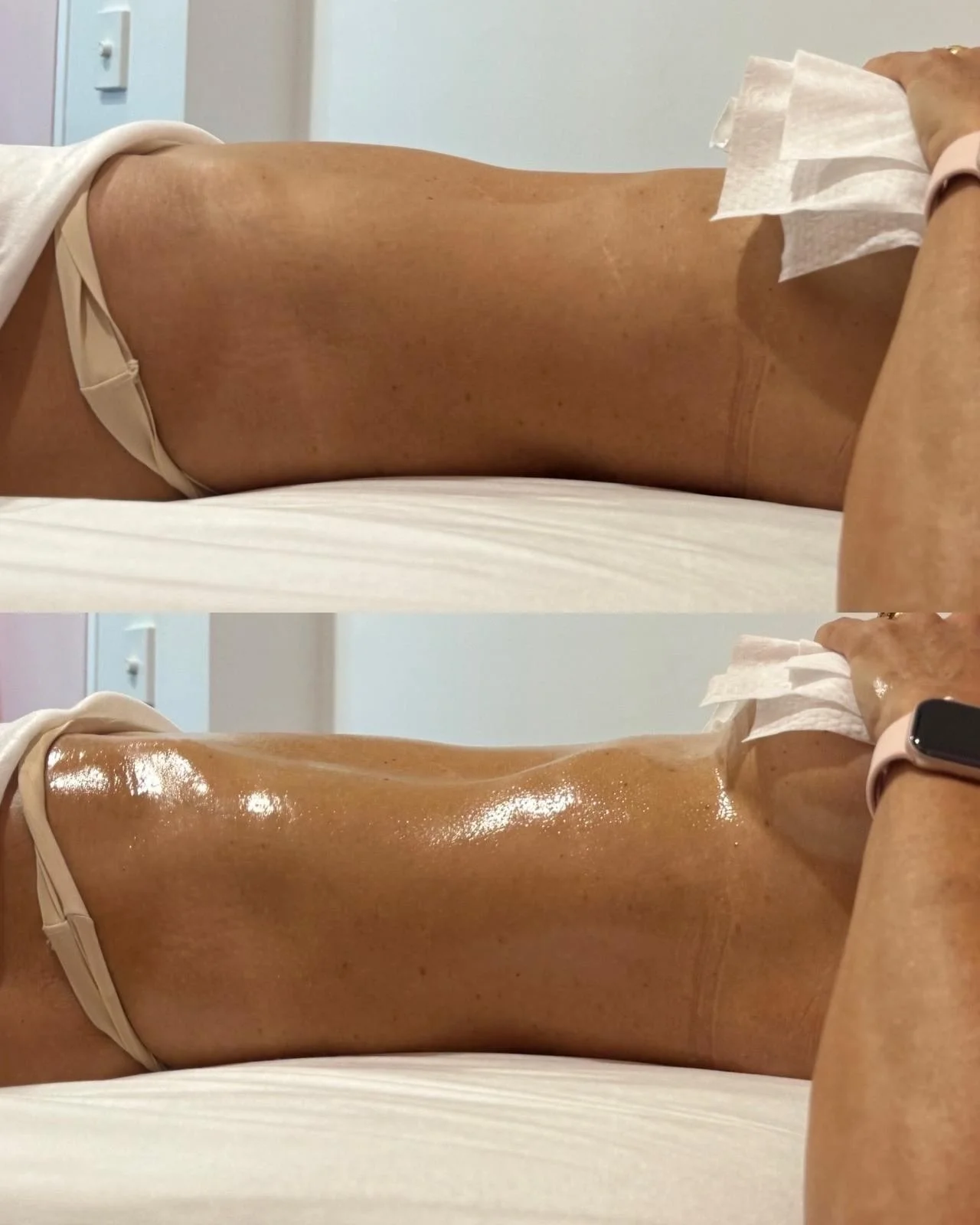 Bloating is not always about digestion.

Before and after lymphatic massage images often reflect changes in fluid movement through the abdomen. When lymphatic flow improves, fluid retention can reduce, and the body may appear less swollen and feel mo