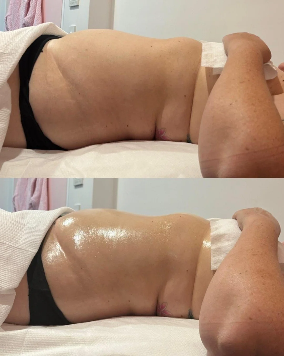 Lipoedema is not a lack of willpower.

It is a medical condition that affects how fat and fluid are stored, most commonly in the legs and arms. It can feel heavy, tight and tender, especially after long days on your feet.

Management is never one dim