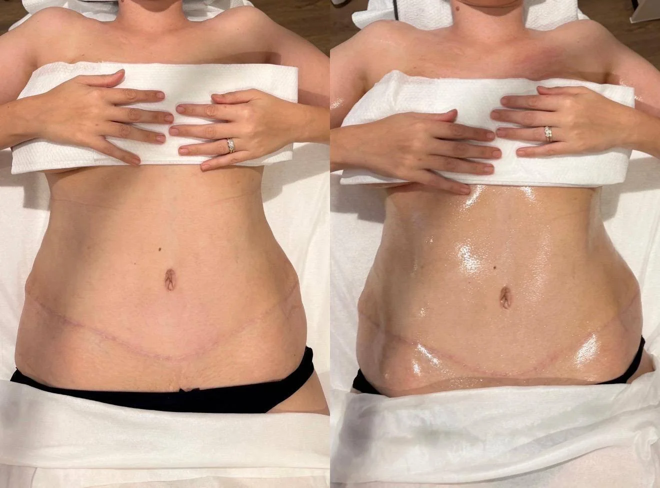If you're planning or recovering from abdominal surgery, lymphatic massage should be part of your plan.

Before surgery, preparing the lymphatic pathways can help the body manage fluid and inflammation more efficiently once the procedure is done. Aft