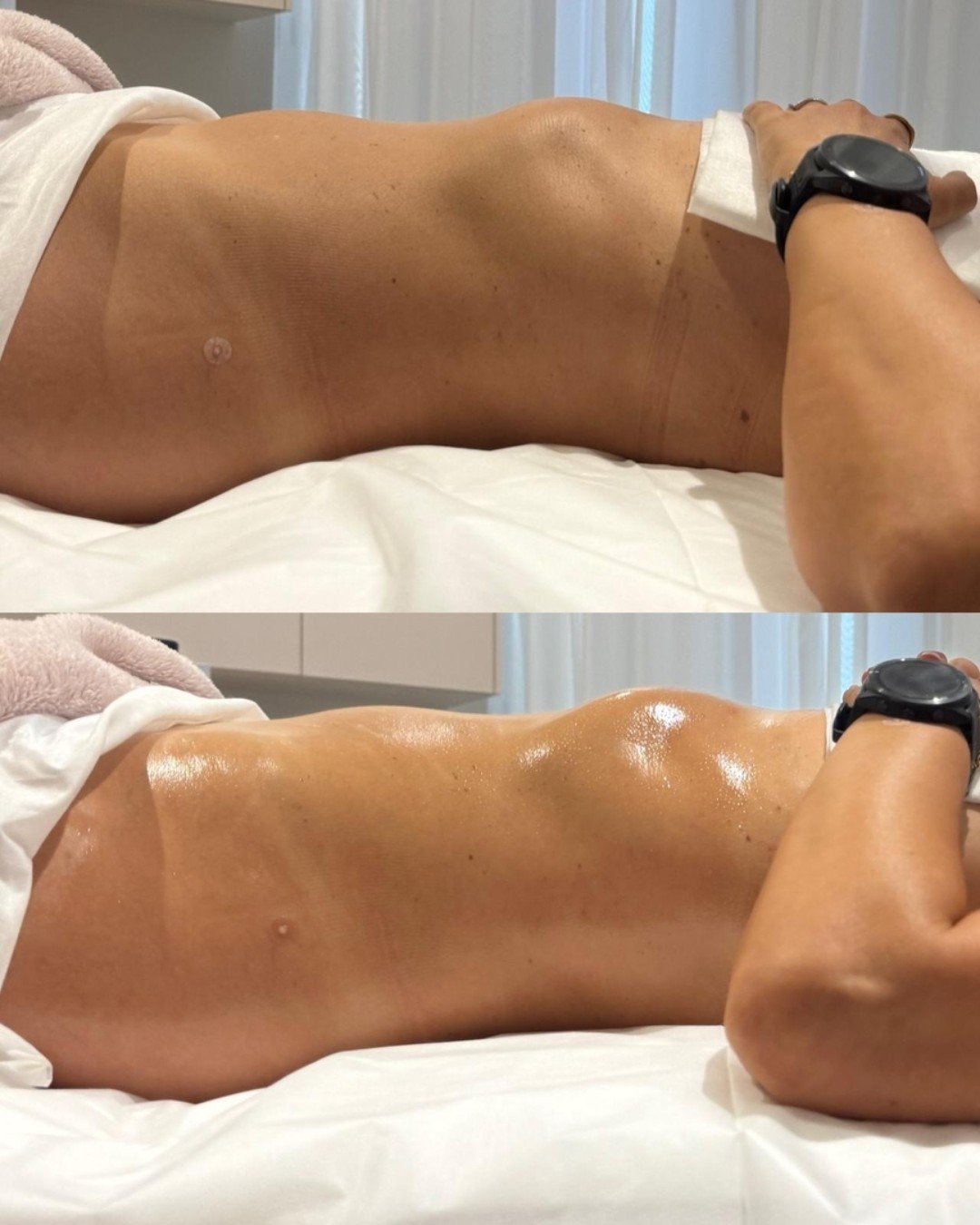Bloating is not always digestive.

In many cases, fluid retention through the abdomen and lower back contributes to that tight, heavy feeling.

Before and after images can reflect how the body responds when lymphatic pathways begin moving more effici