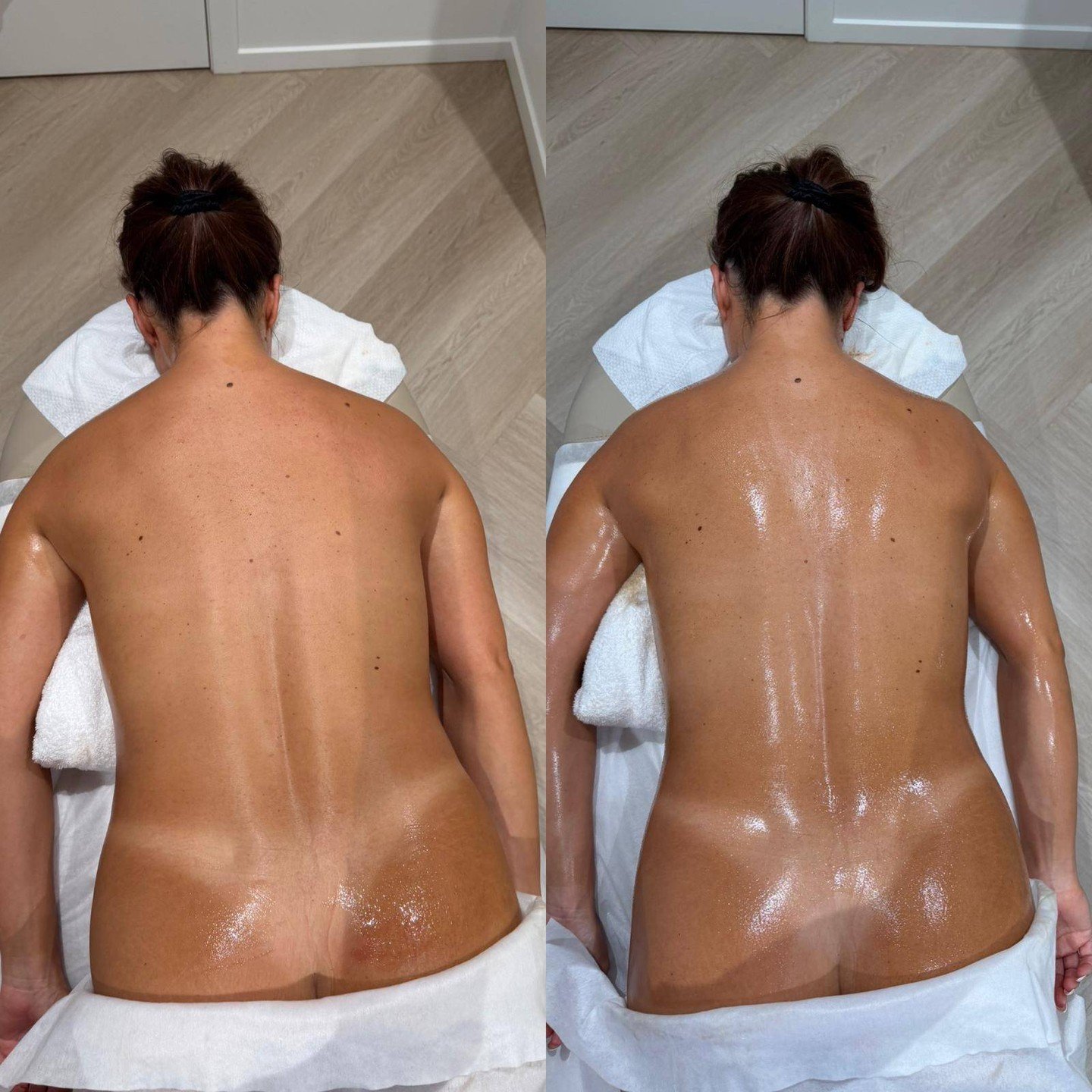 Fluid doesn't only accumulate at the front of the body. The back, flanks and sides hold a significant amount, and it's often the last place people think to address.

What you're seeing here is the result of consistent lymphatic work through the poste