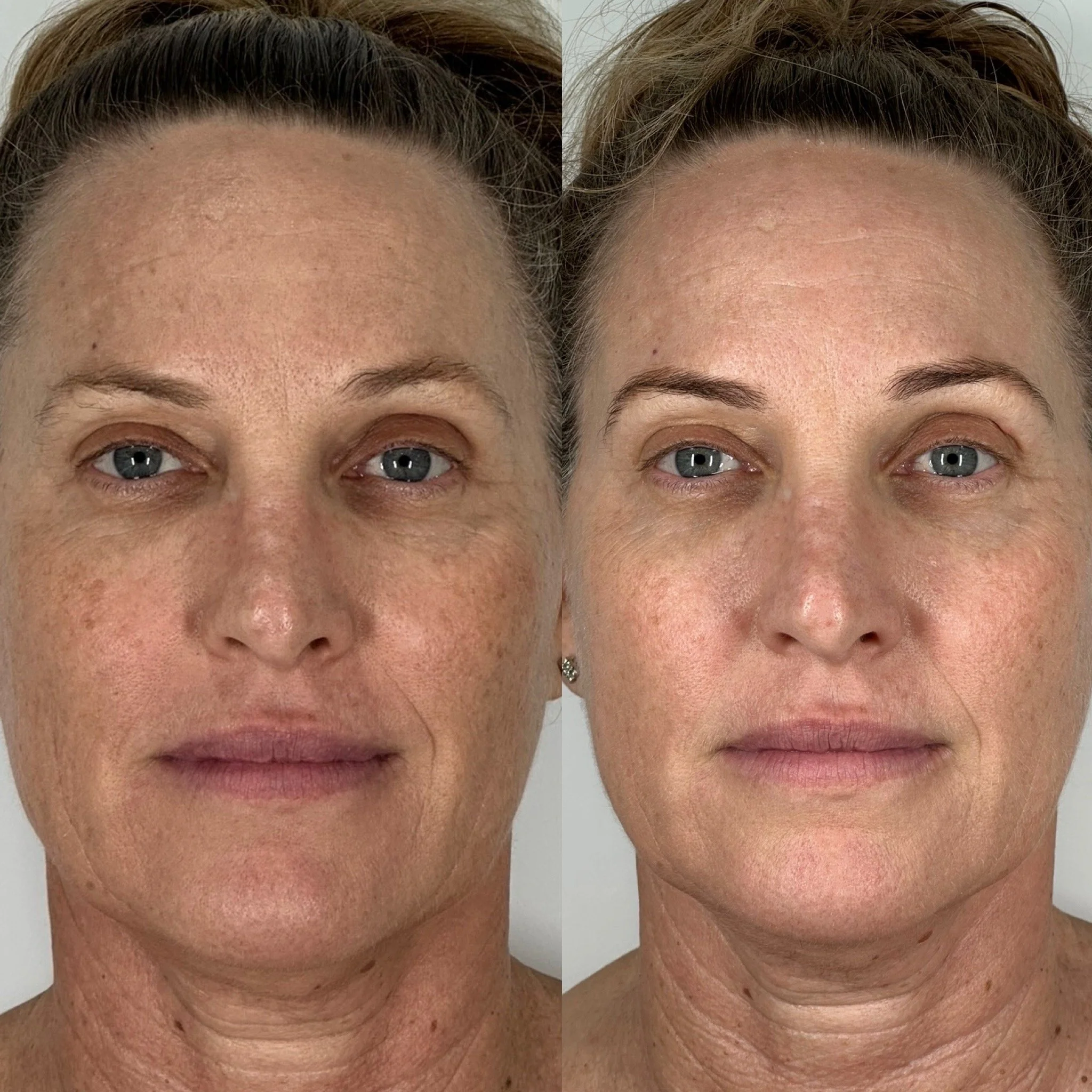 treatment results before and after comparison, Addesso Clinic Townsville - individual results vary based on skin type and treatment plan