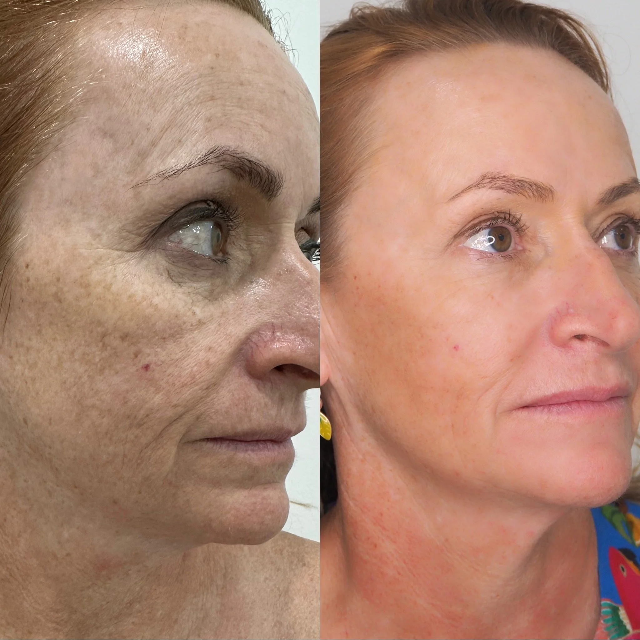 Dermapen Exosome treatment results before and after comparison, Addesso Clinic Townsville - individual results vary based on skin type and treatment plan