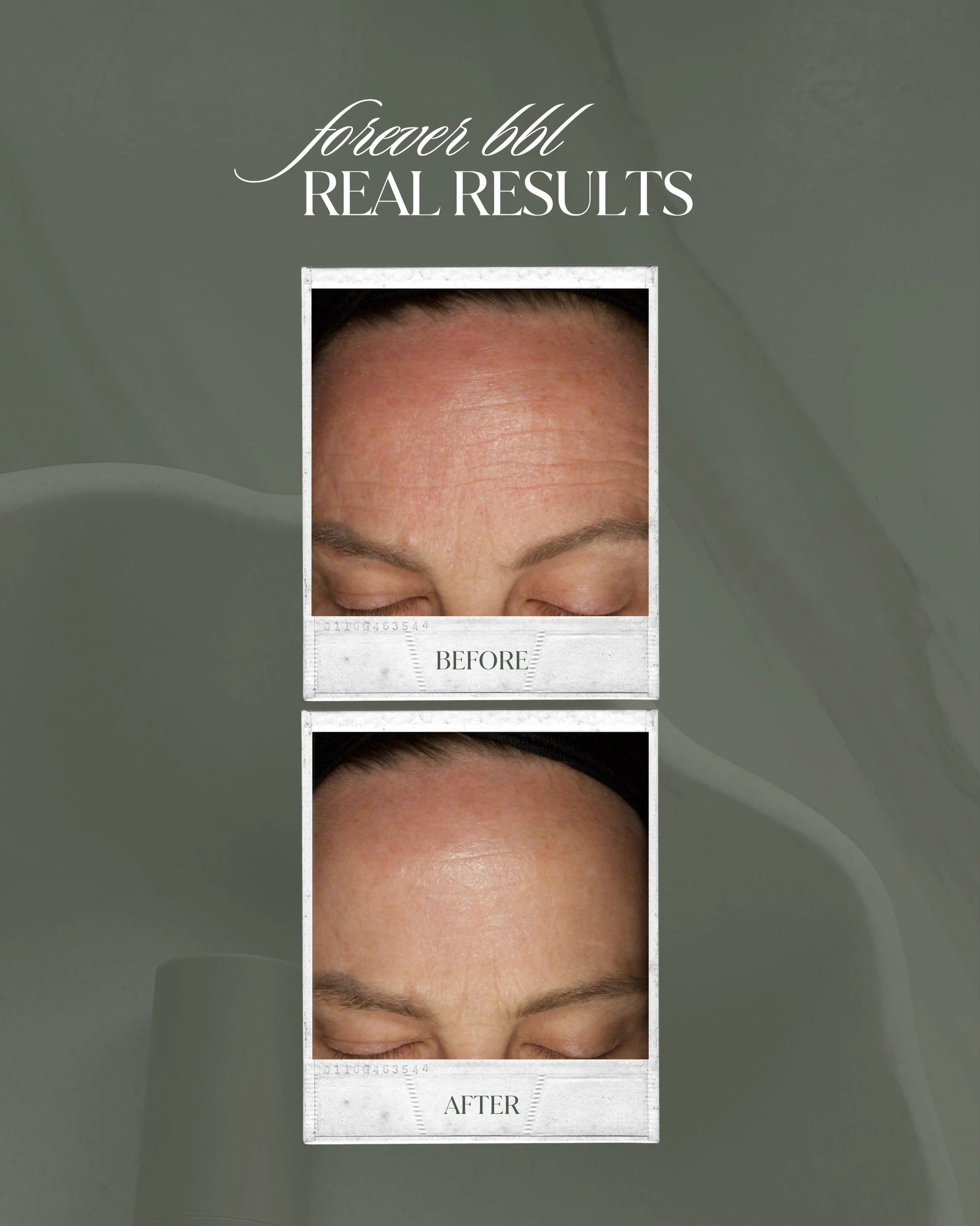 Smoother. Brighter. More youthful-looking skin.

BBL treatments help target visible signs of aging including sun damage, pigmentation, redness, and uneven skin tone.

These results truly speak for themselves 🤍
#foreveryoungbbl #antiaging #lasertreat