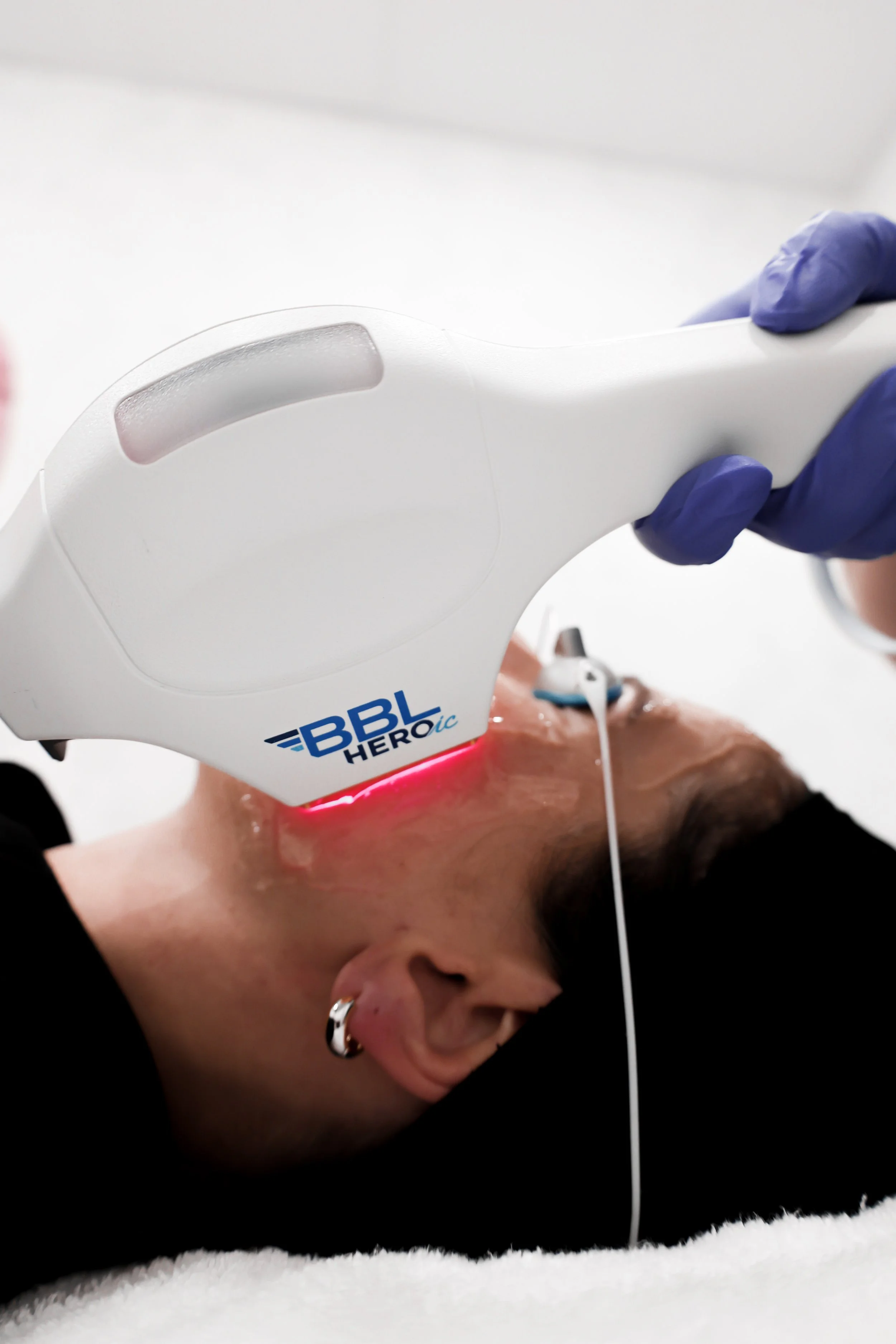 Person undergoing laser skin treatment on face with BBL HERO device in a medical clinic.