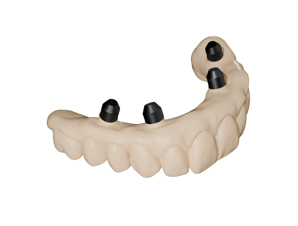 Existing Prosthesis Extra-Oral Scan