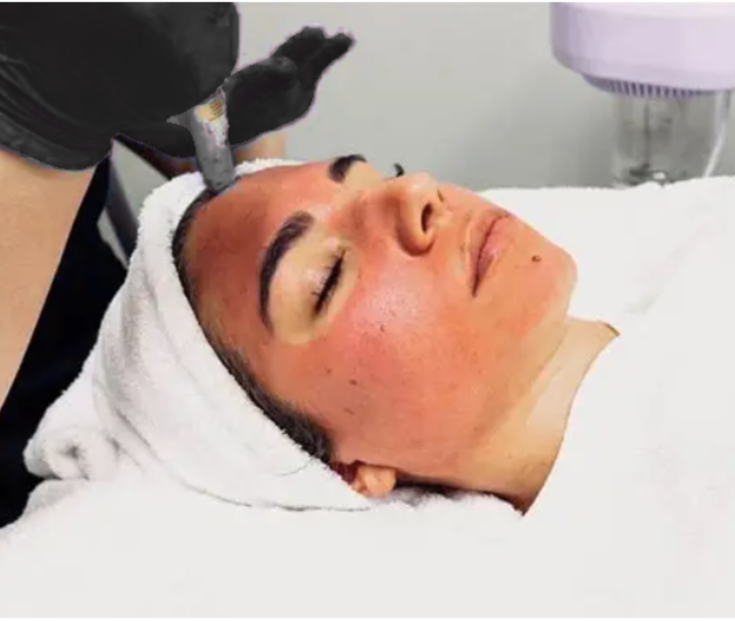 Vampire Micro Needling.png