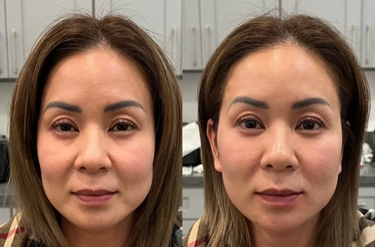 PRP Look Book nasolabial .png