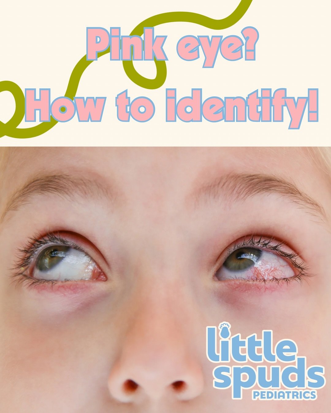 👁️ How to Tell If It&rsquo;s Pink Eye!(Conjunctivitis)

Not all red, irritated eyes are created equal. Here&rsquo;s a quick guide to the common causes of pink eye to help you know what to look for:

🔬 Bacterial Conjunctivitis &bull; Thick, purulent