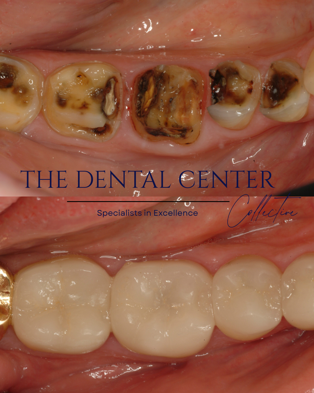 Do I Need a Crown or a Filling? How to Know Which Treatment Is Right for Your Tooth