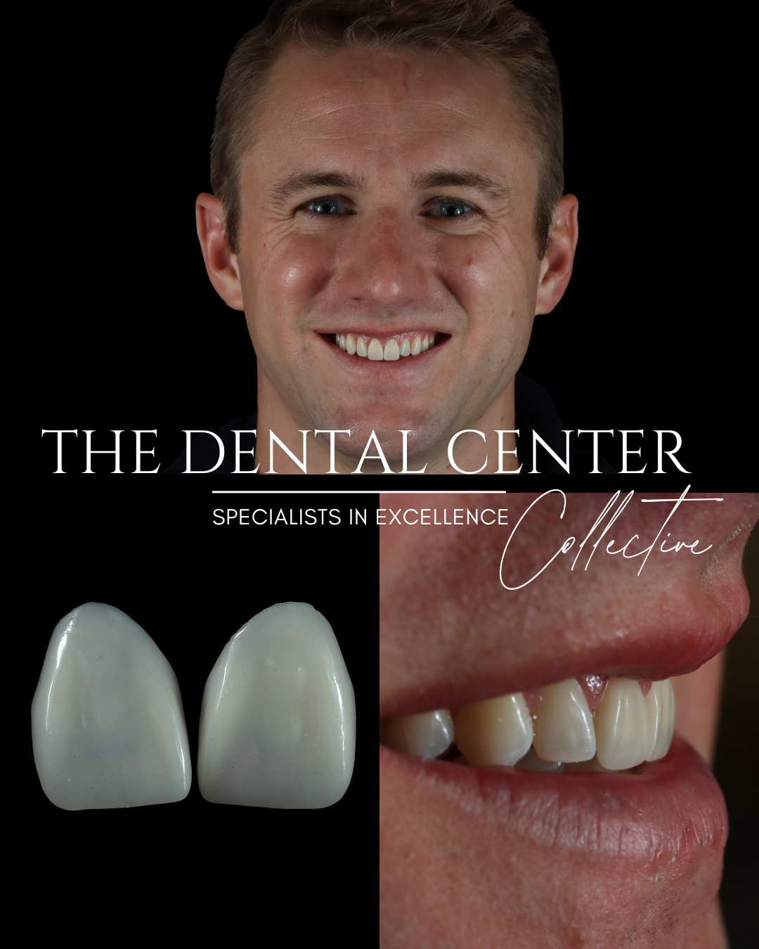 Dental Veneers: What They Are, How They Work, and Whether They’re Right for You