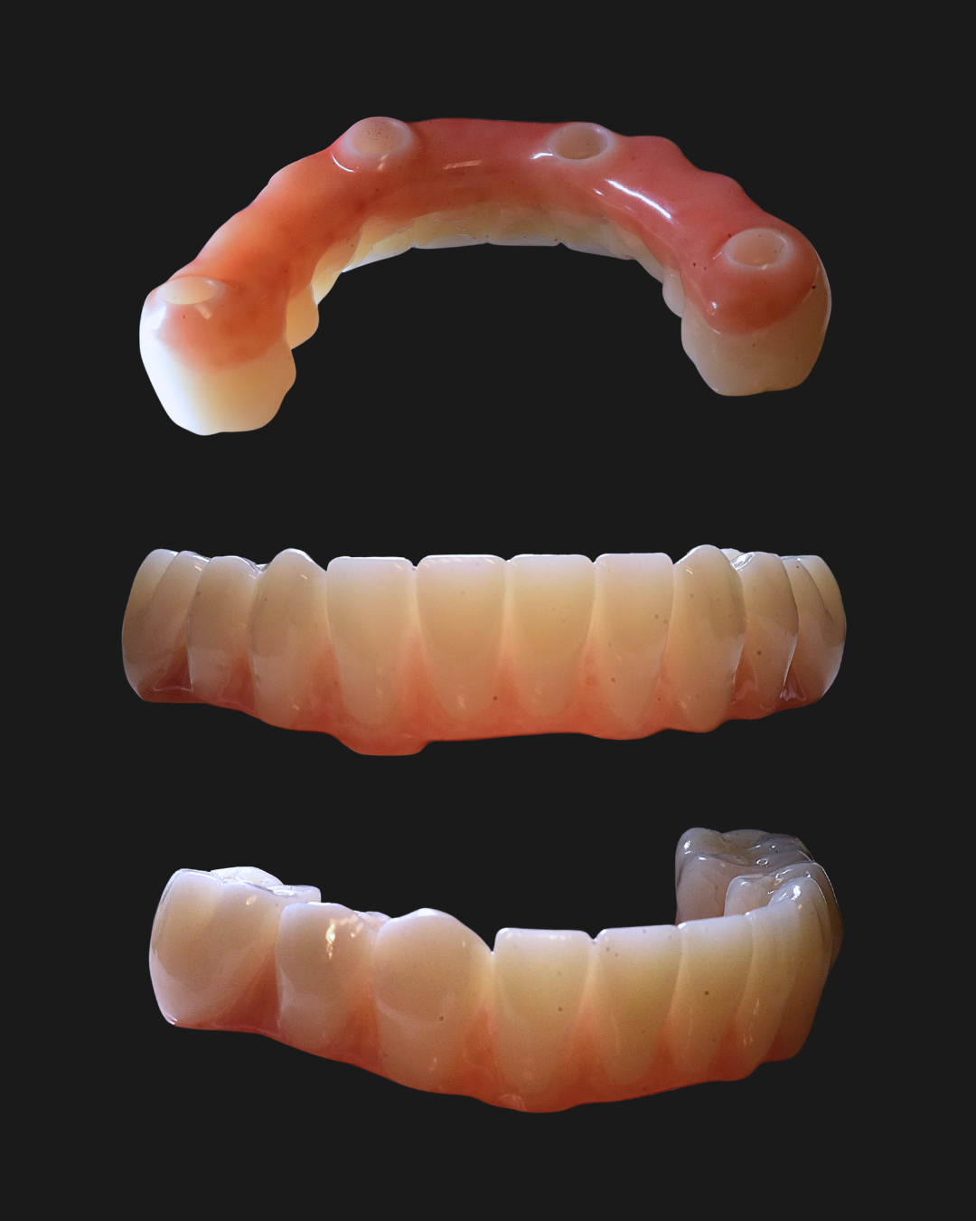 All-on-4 Implants: Understanding Your Prosthesis Material Options