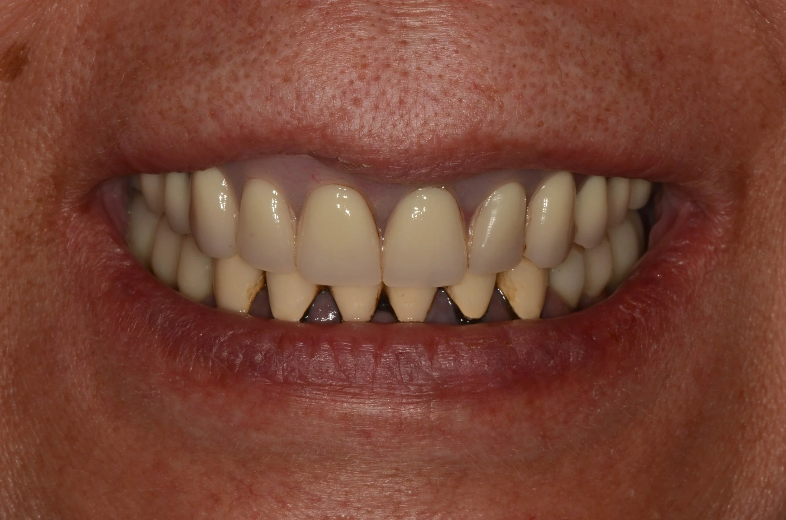 Why Full-Arch Dental Implants Sometimes Fail — and How an Experienced Team Can Fix Them