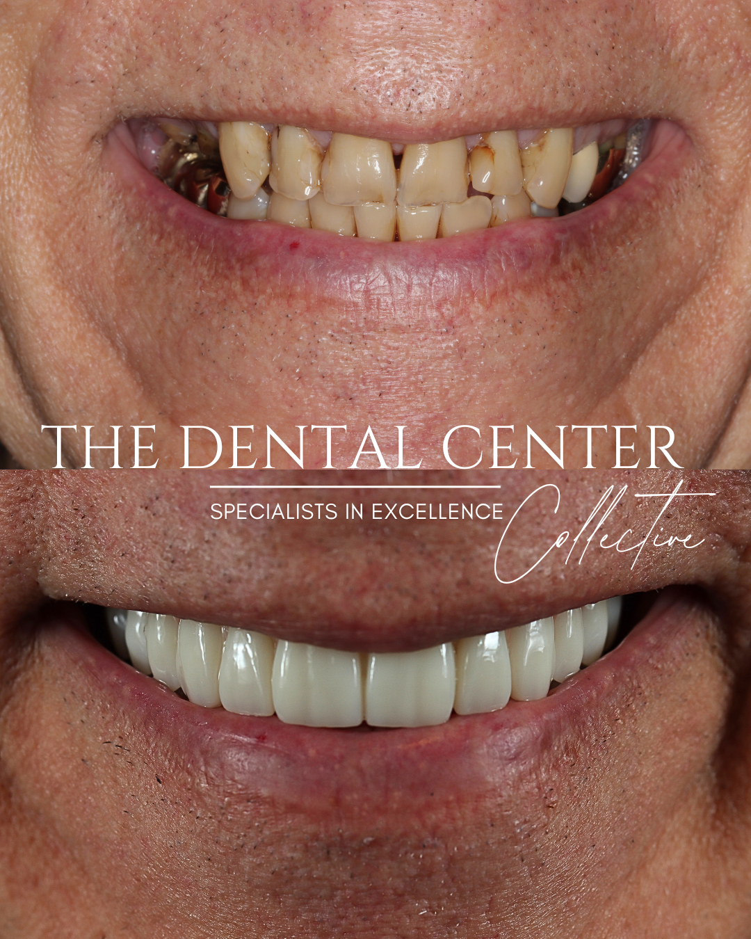 Common Misconceptions About All-on-4 Dental Implants (And the Truth Behind Them)