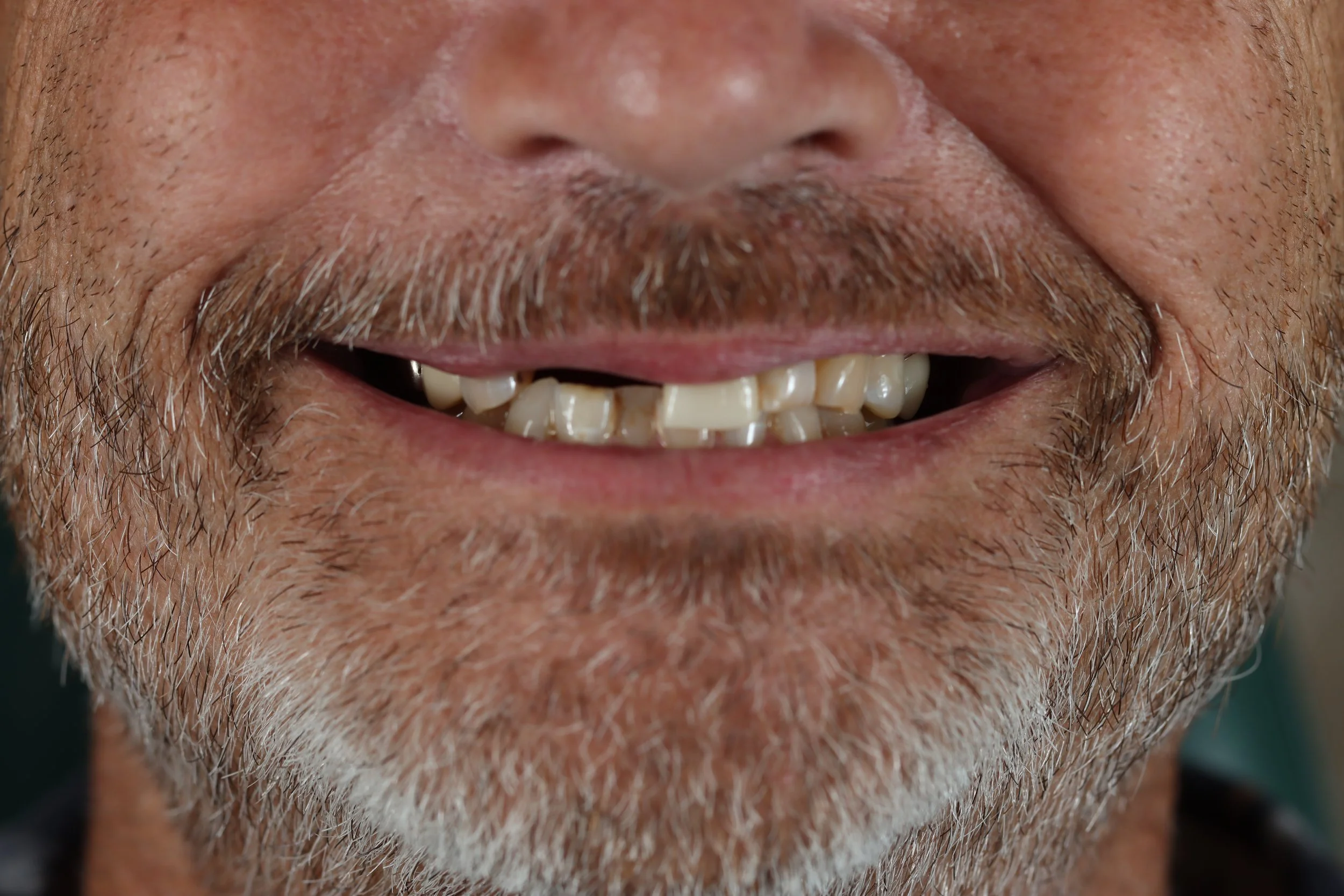 What Happens If I Don’t Replace a Missing Tooth?