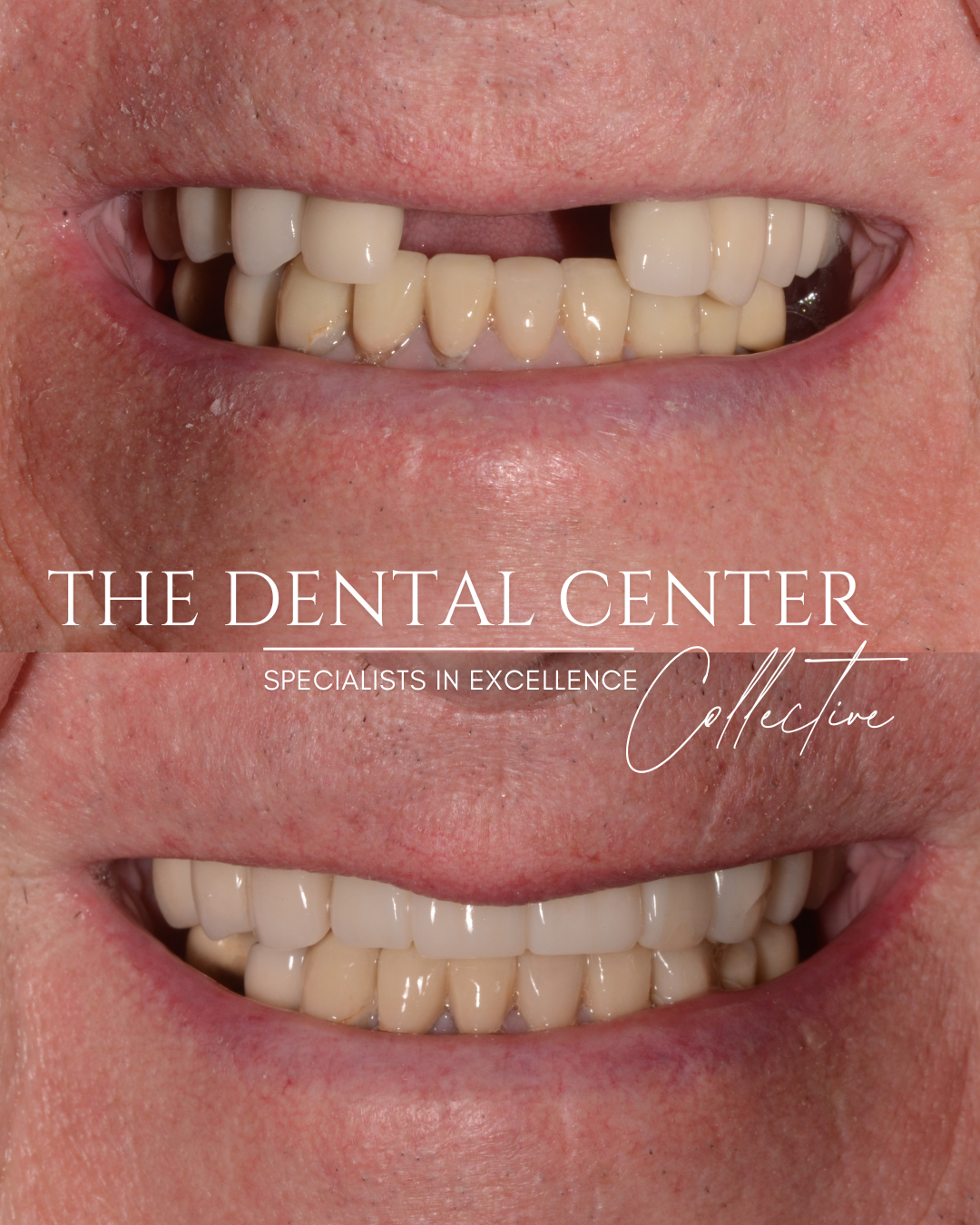 Patient in temporary teeth immediately after implant surgery.