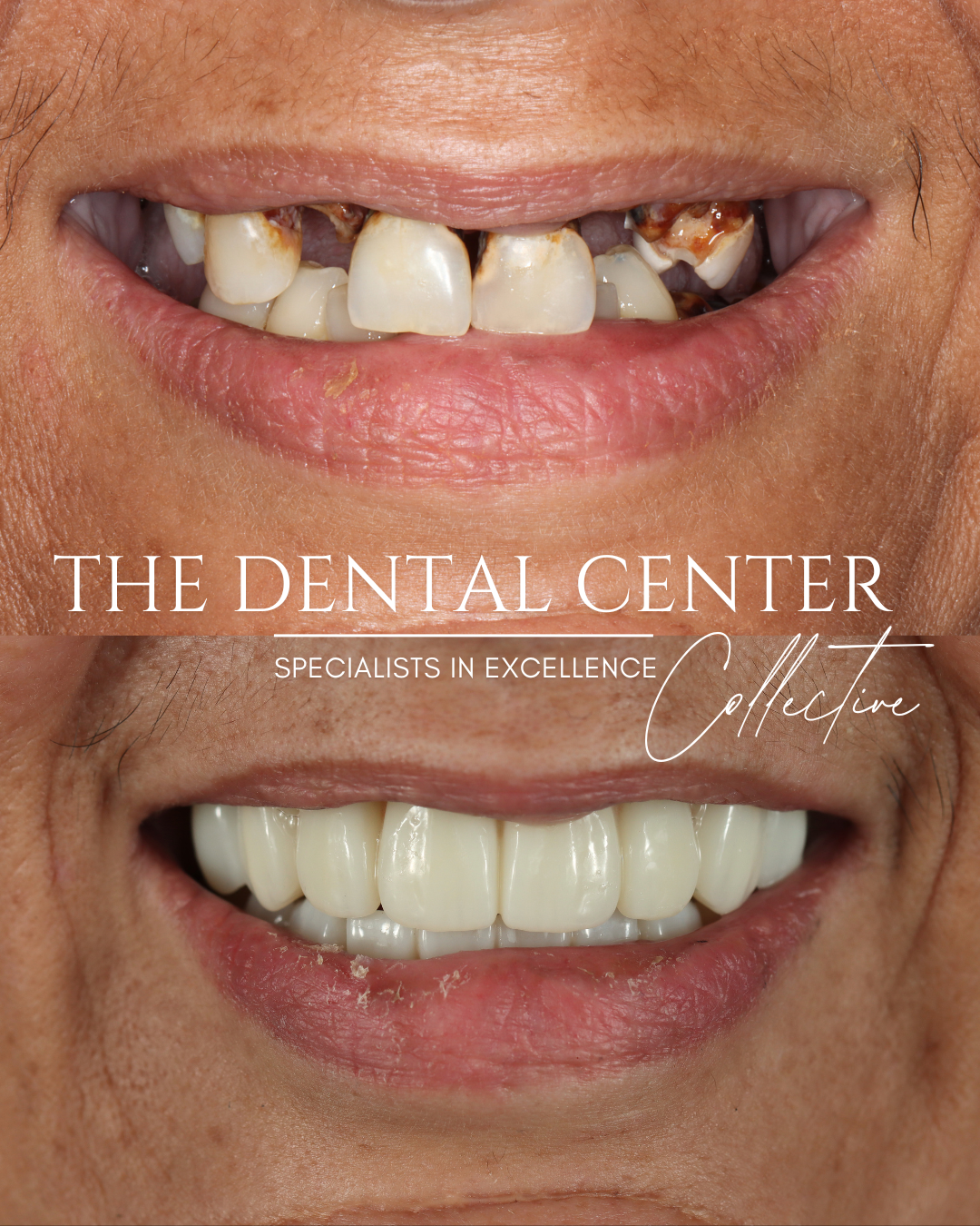 Dental implant smile restoration replacing failing teeth with a custom-designed full-arch bridge for improved function and natural esthetics.