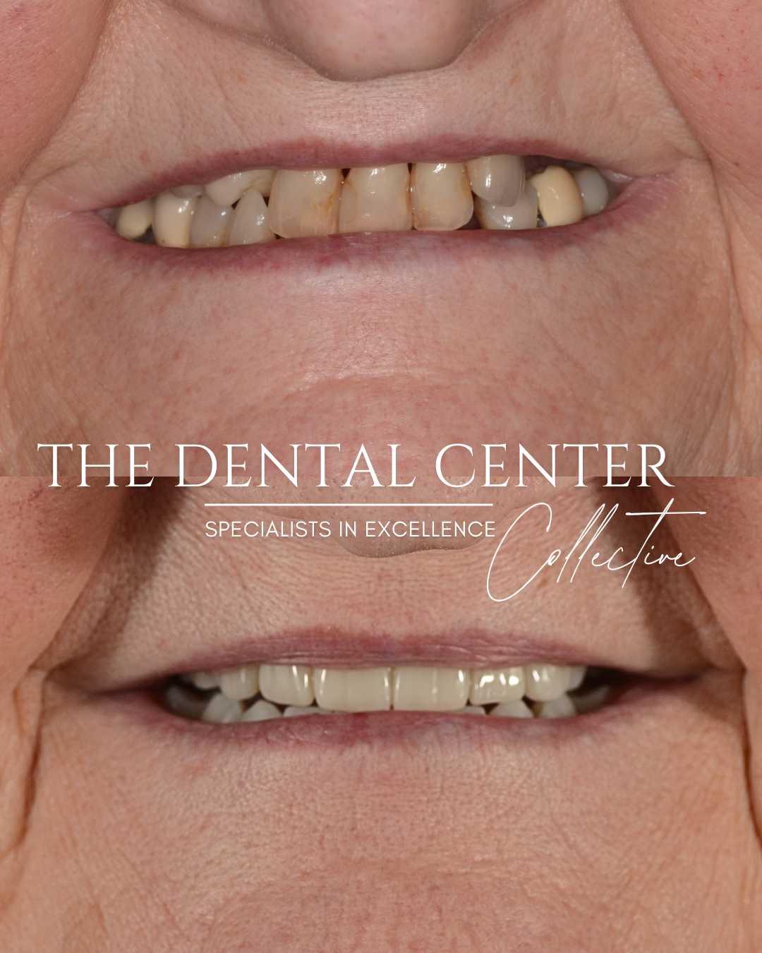 Before and after implant dentistry case demonstrating restoration of severely compromised teeth with a fixed full-arch prosthesis.