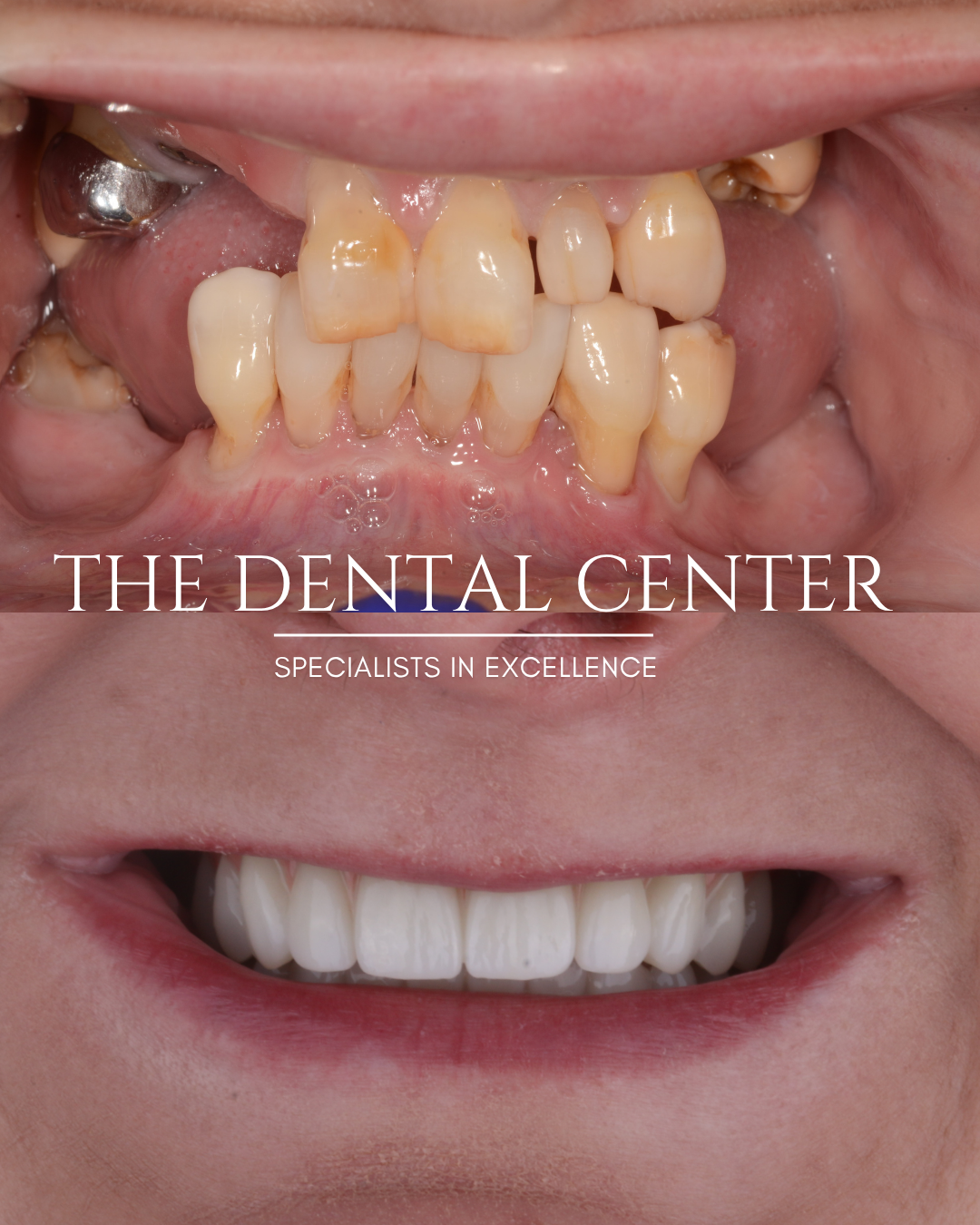 Before and after full-arch dental implant restoration replacing severely broken and decayed teeth with a natural-looking fixed implant-supported smile.