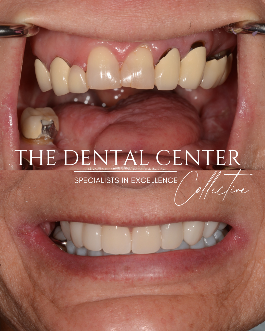 Smile makeover with dental implants after loss of teeth due to cancer. 